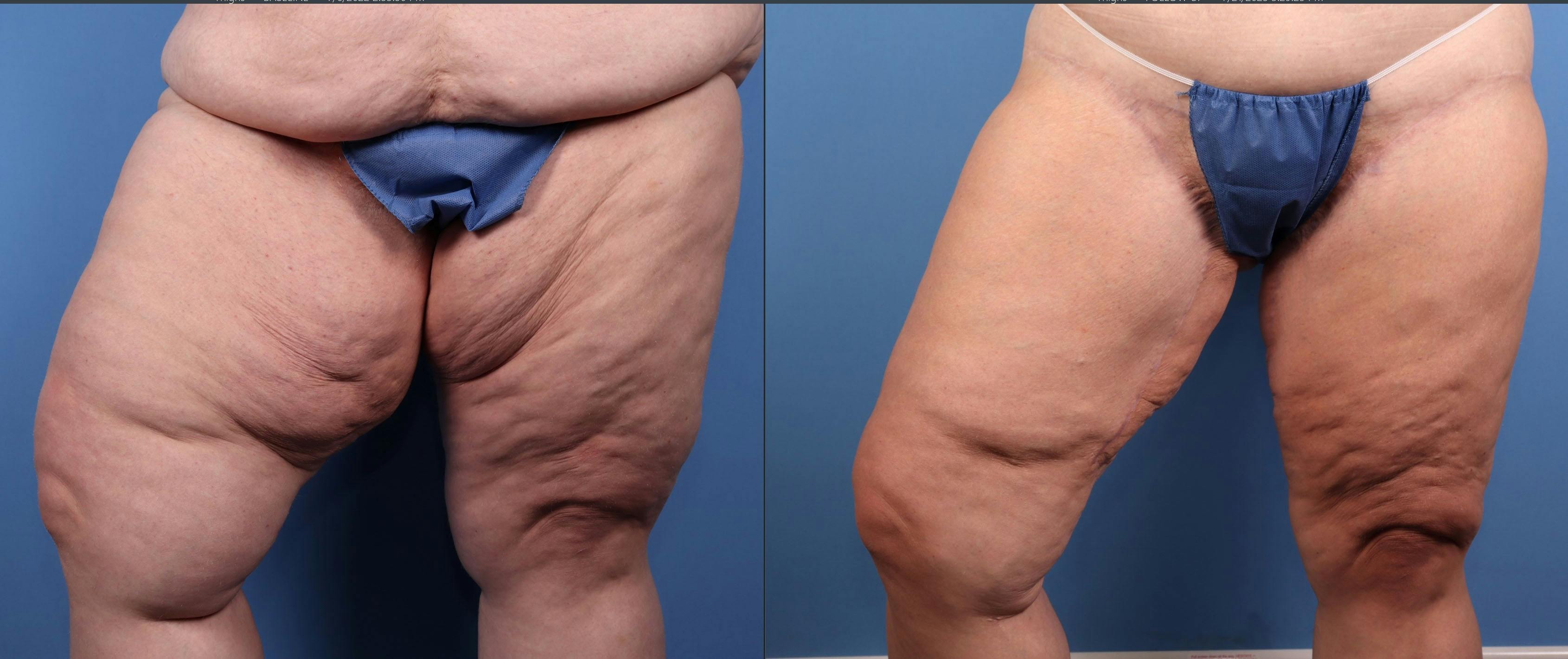 Thigh Lift Before & After Gallery - Patient 194953 - Image 3
