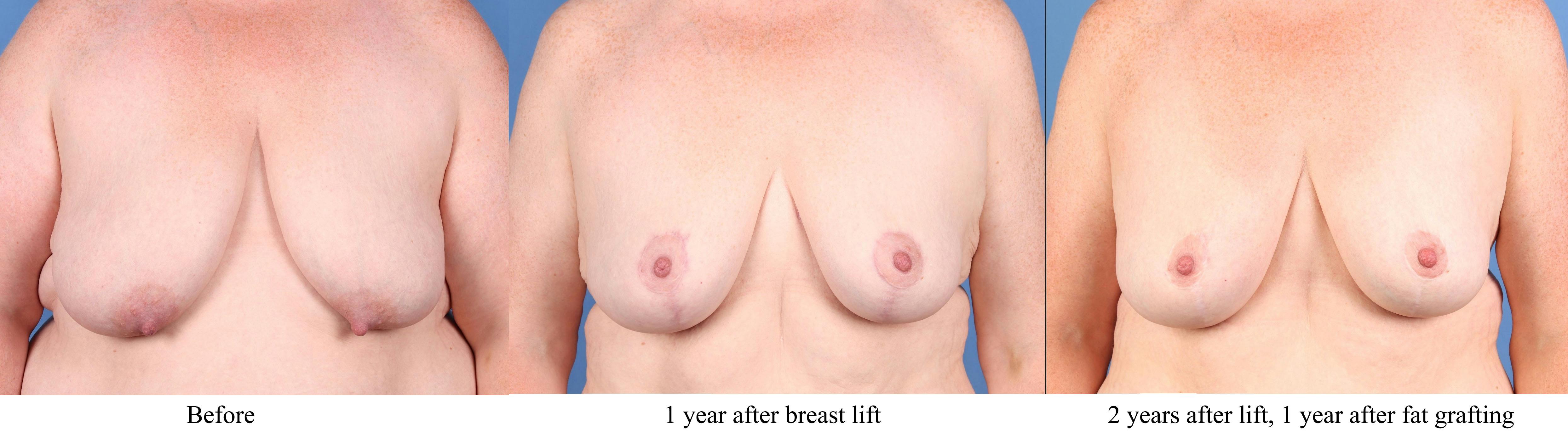 Breast Lift Before & After Gallery - Patient 131694 - Image 2