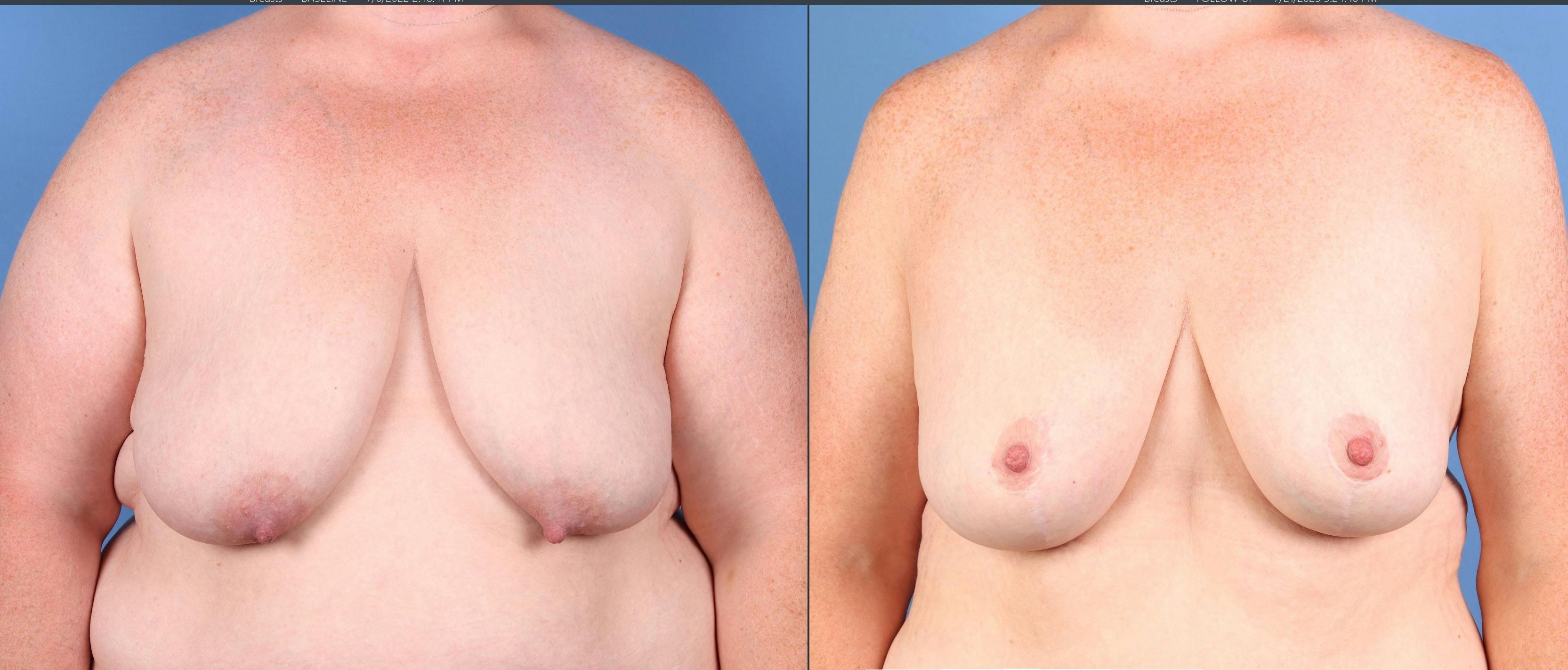 Breast Lift Before & After Gallery - Patient 131694 - Image 1