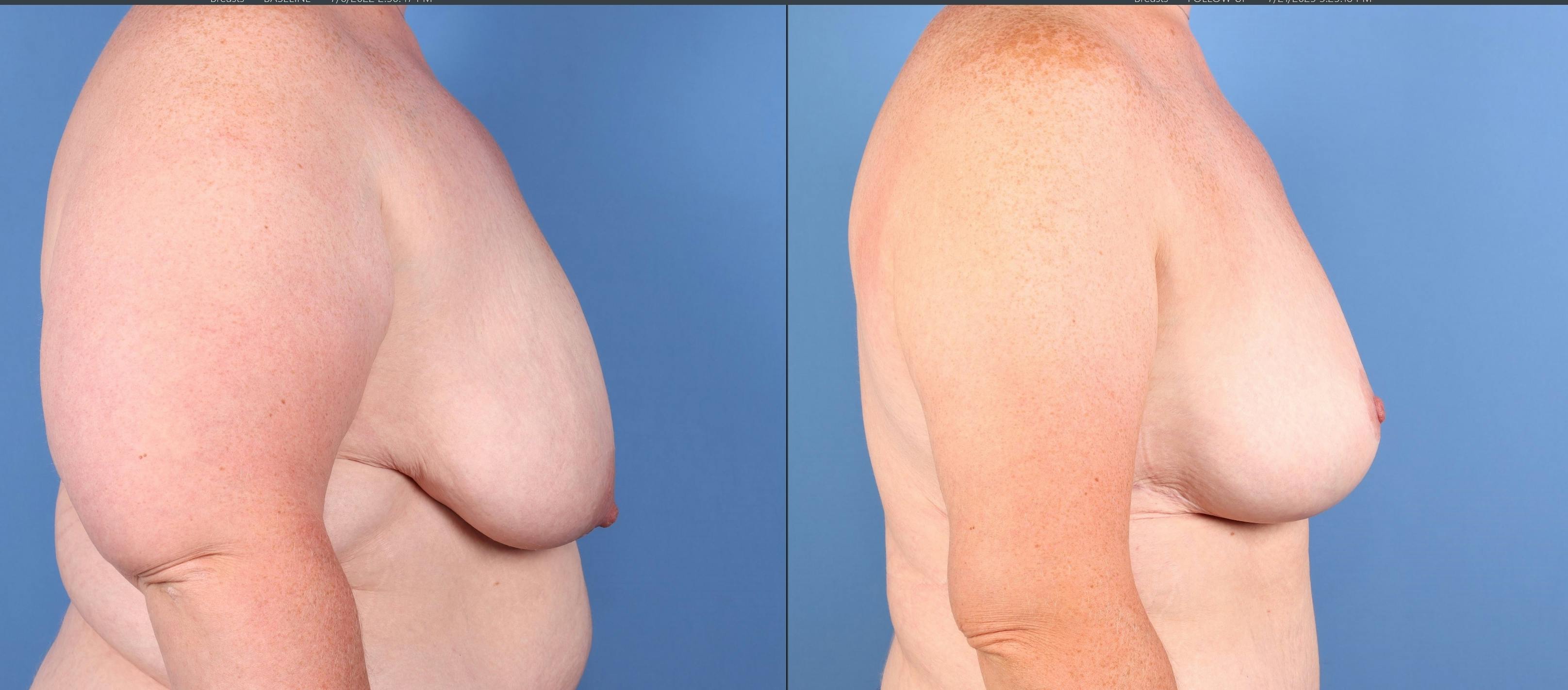 Breast Lift Before & After Gallery - Patient 131694 - Image 4
