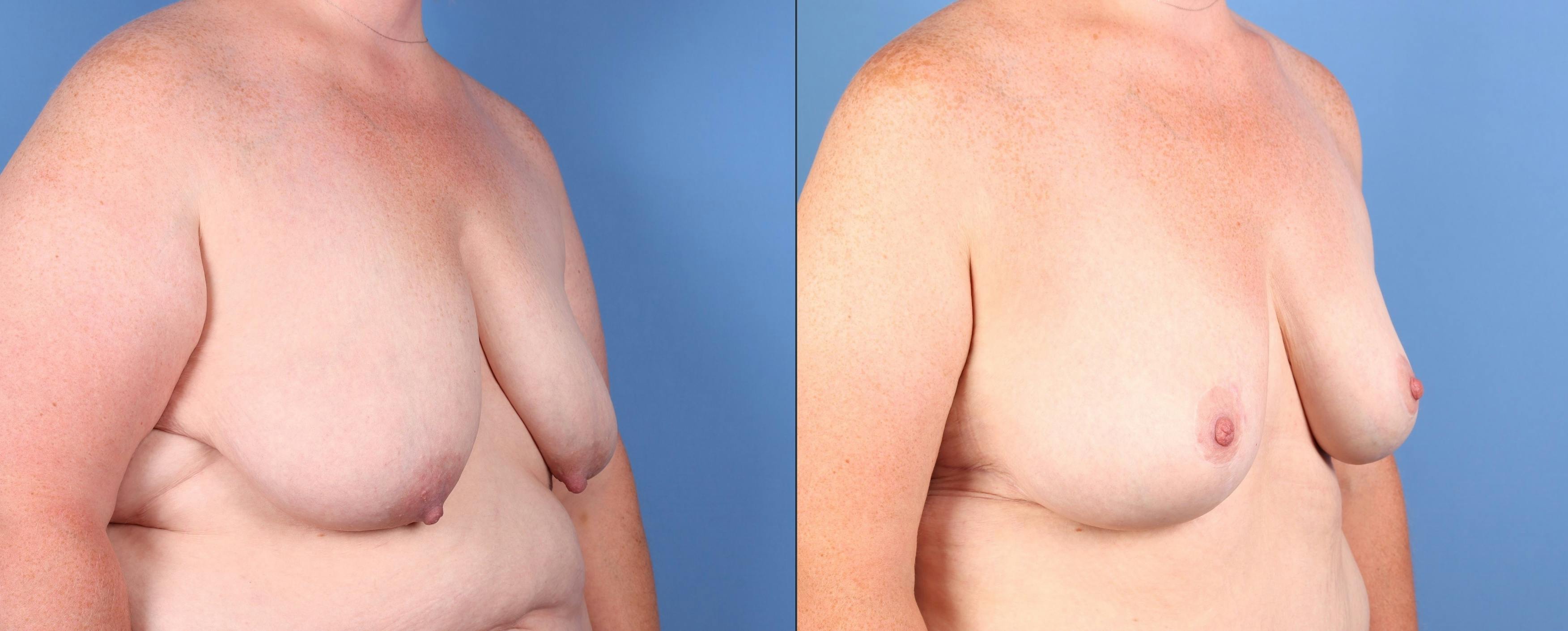 Breast Lift Before & After Gallery - Patient 131694 - Image 3