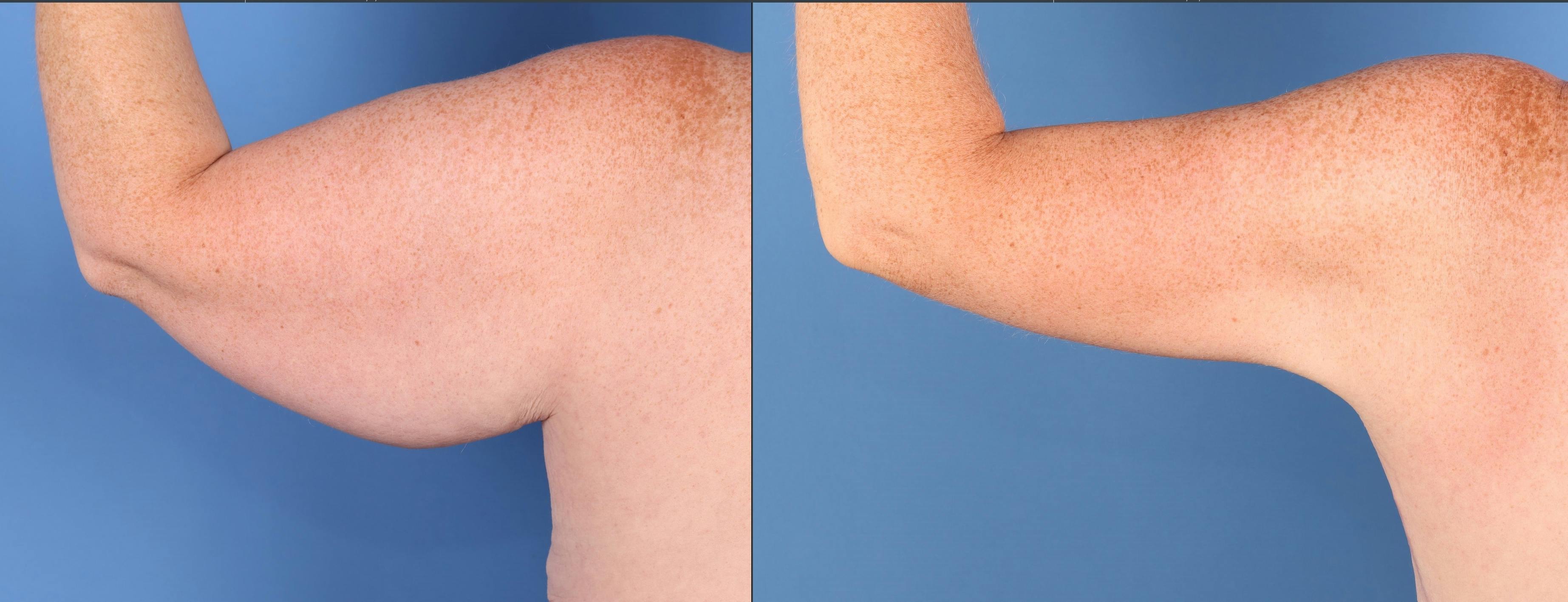 Arm Lift Before & After Gallery - Patient 291505 - Image 1