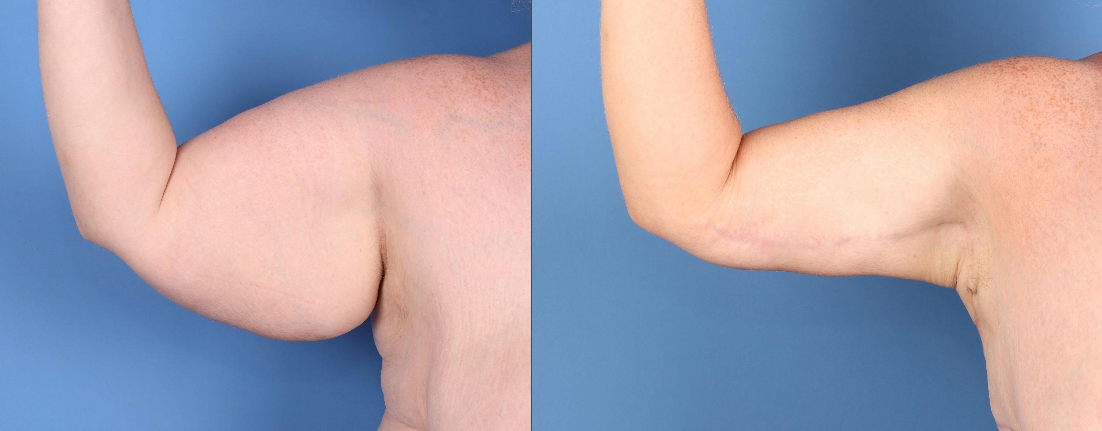 Arm Lift Before & After Gallery - Patient 291505 - Image 2
