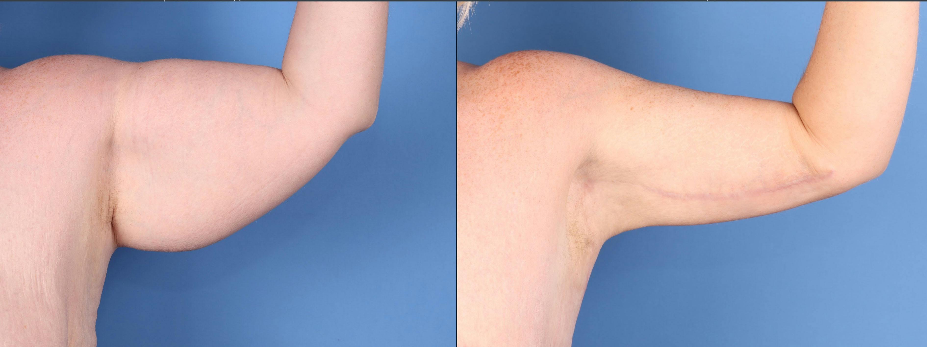Arm Lift Before & After Gallery - Patient 291505 - Image 4