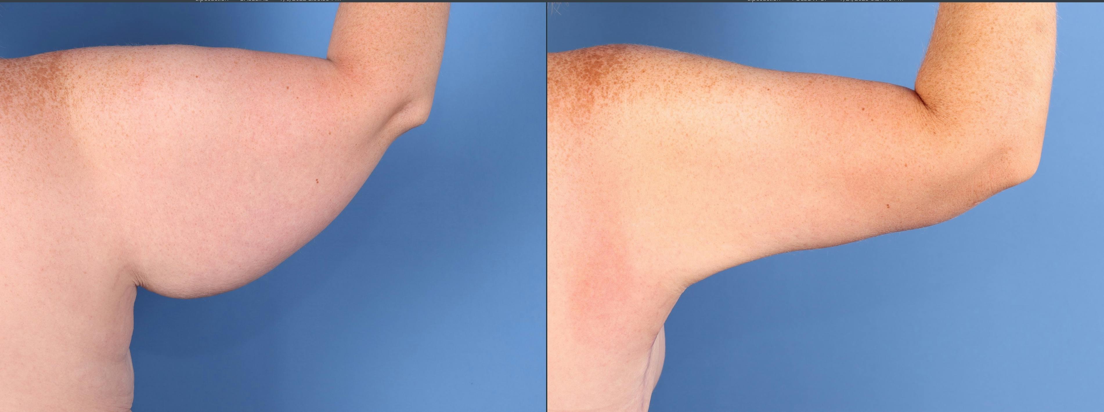 Arm Lift Before & After Gallery - Patient 291505 - Image 3