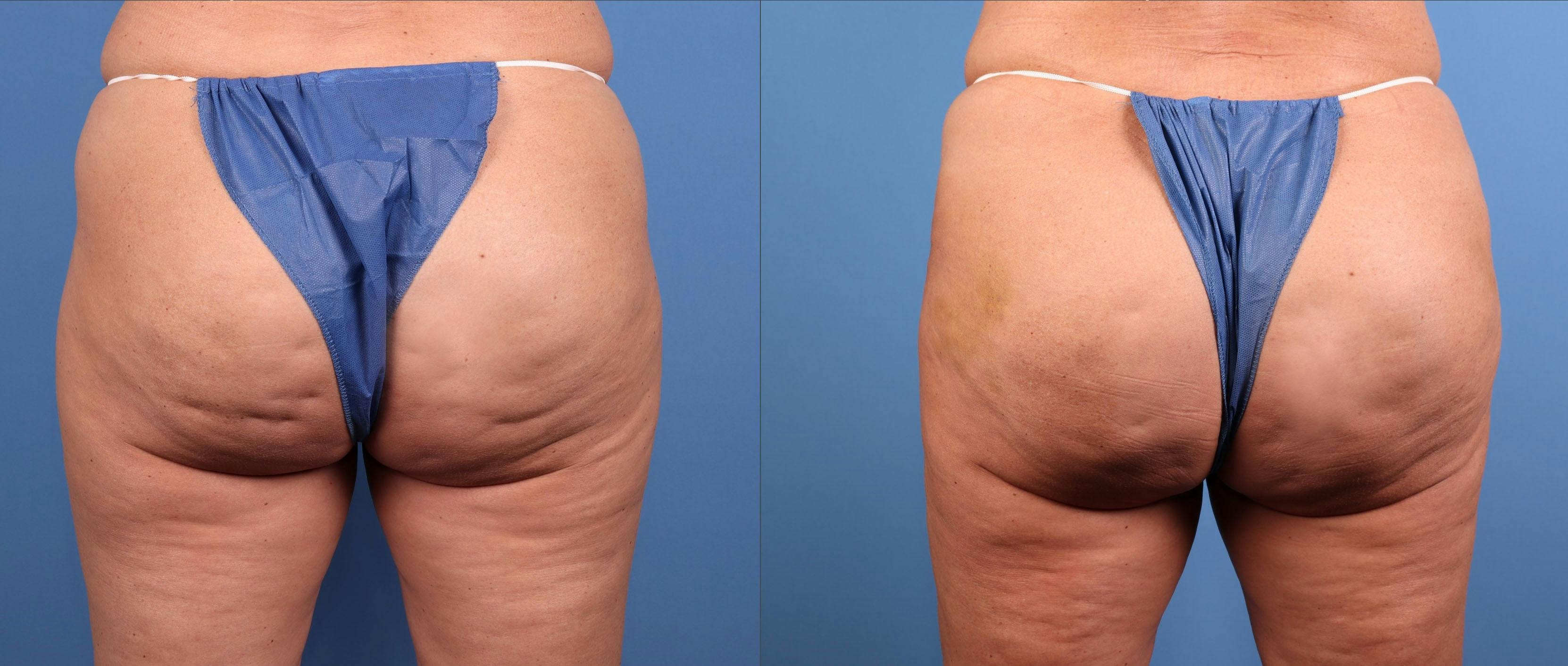 Cellulite Treatment Before & After Gallery - Patient 348839 - Image 1
