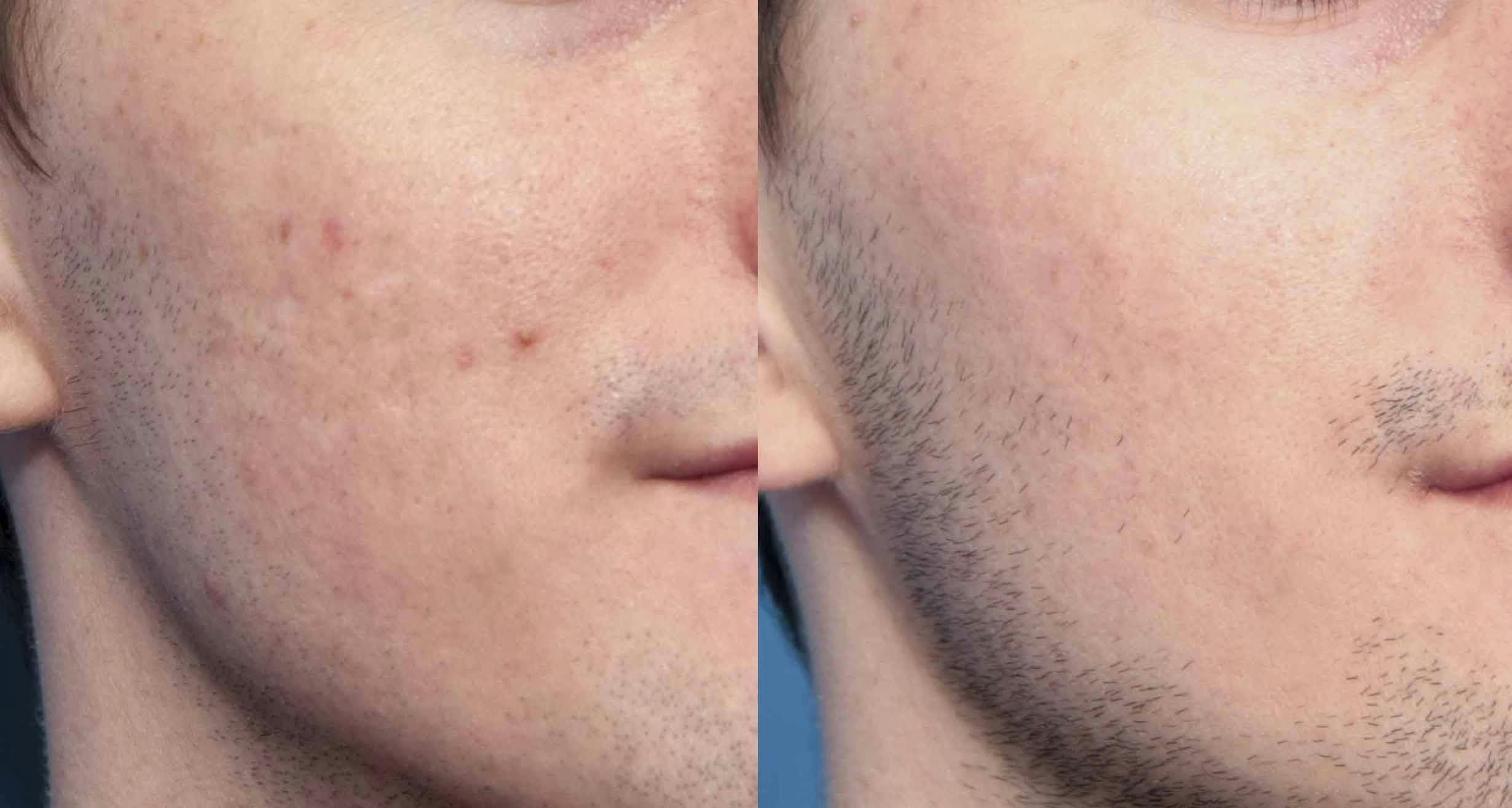 Acne Scar Treatment Before & After Gallery - Patient 195774 - Image 3