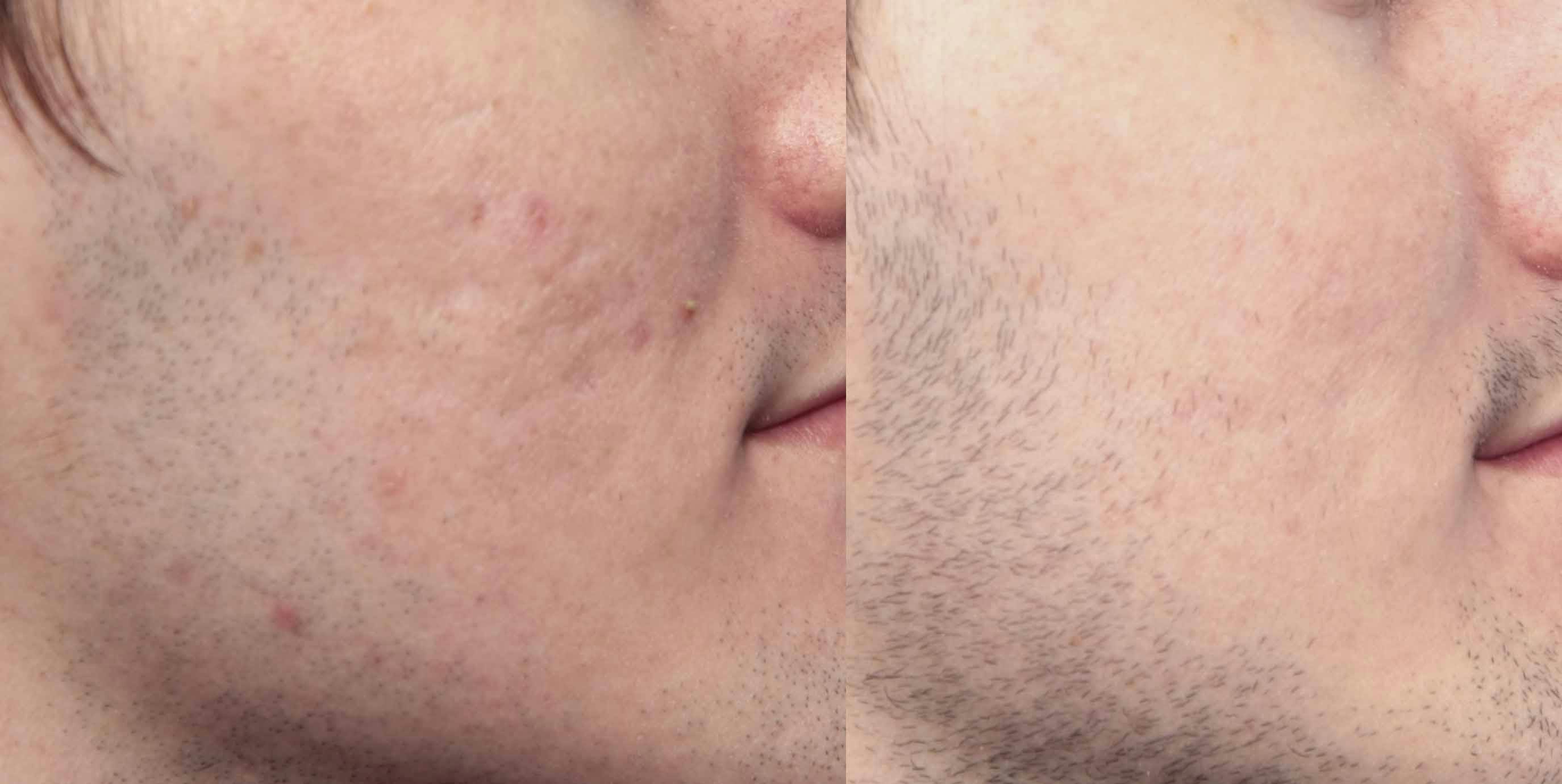 Acne Scar Treatment Before & After Gallery - Patient 195774 - Image 2