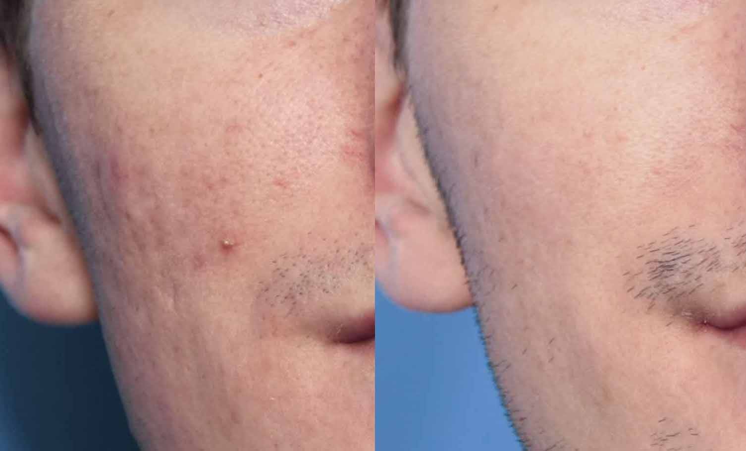 Acne Scar Treatment Before & After Gallery - Patient 195774 - Image 1