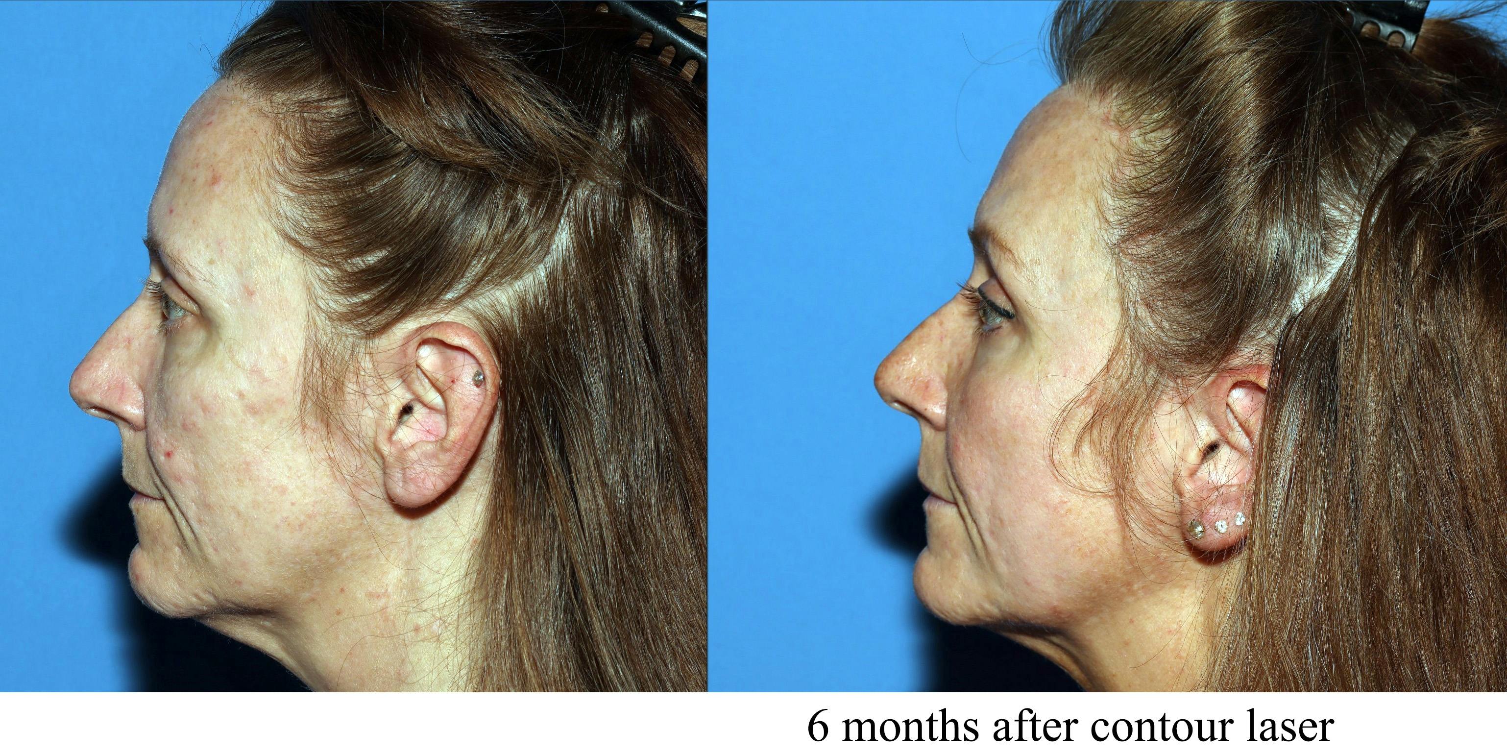 Acne Scar Treatment Before & After Gallery - Patient 465721 - Image 5