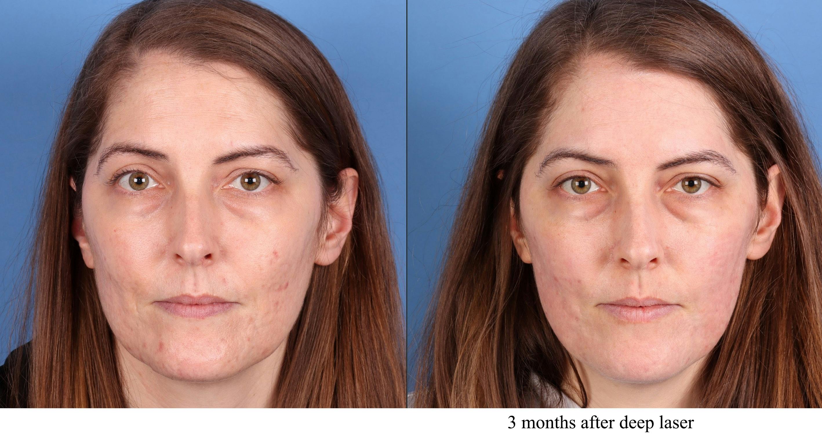 Acne Scar Treatment Before & After Gallery - Patient 364535 - Image 2