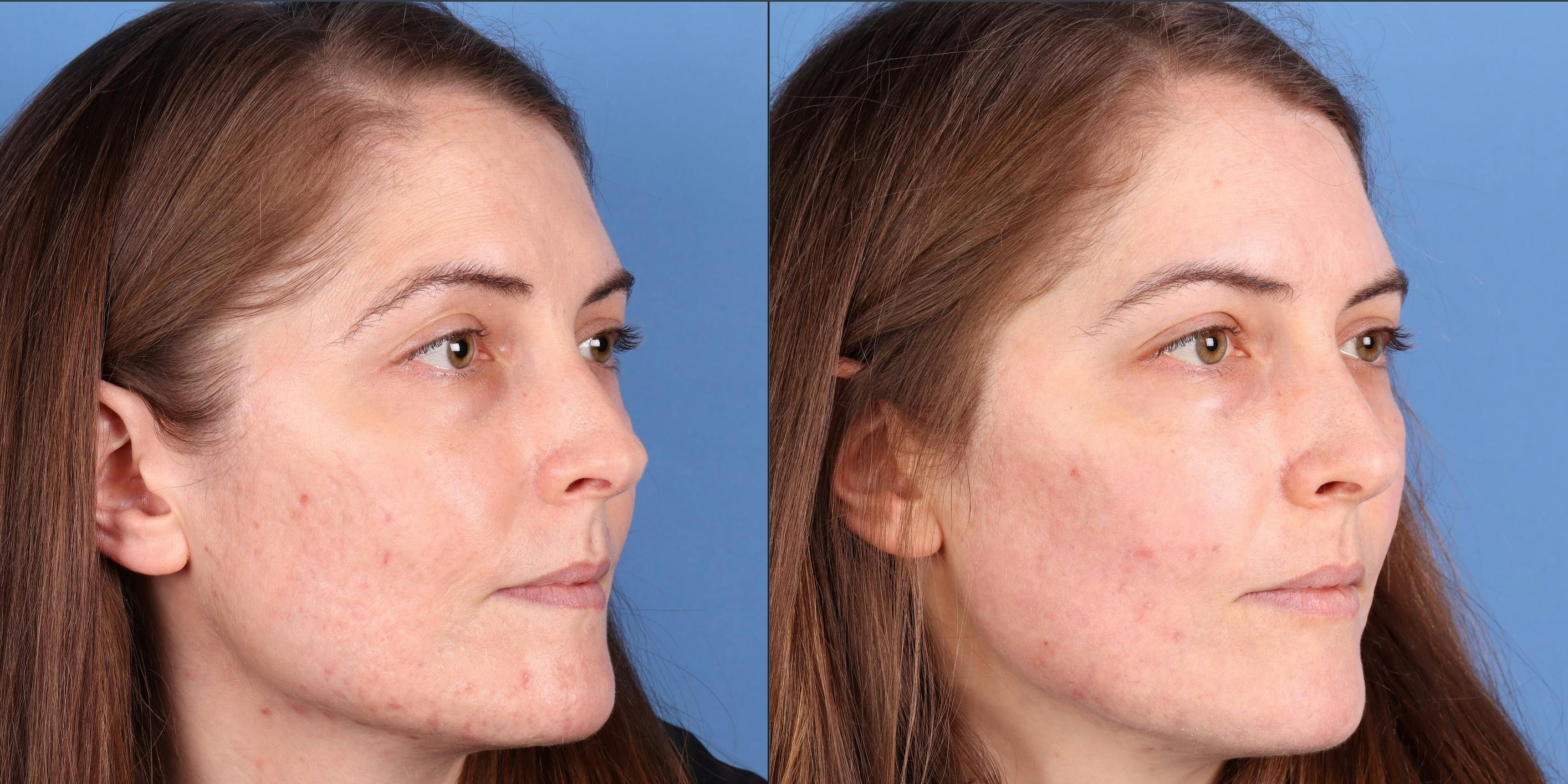 Acne Scar Treatment Before & After Gallery - Patient 364535 - Image 3