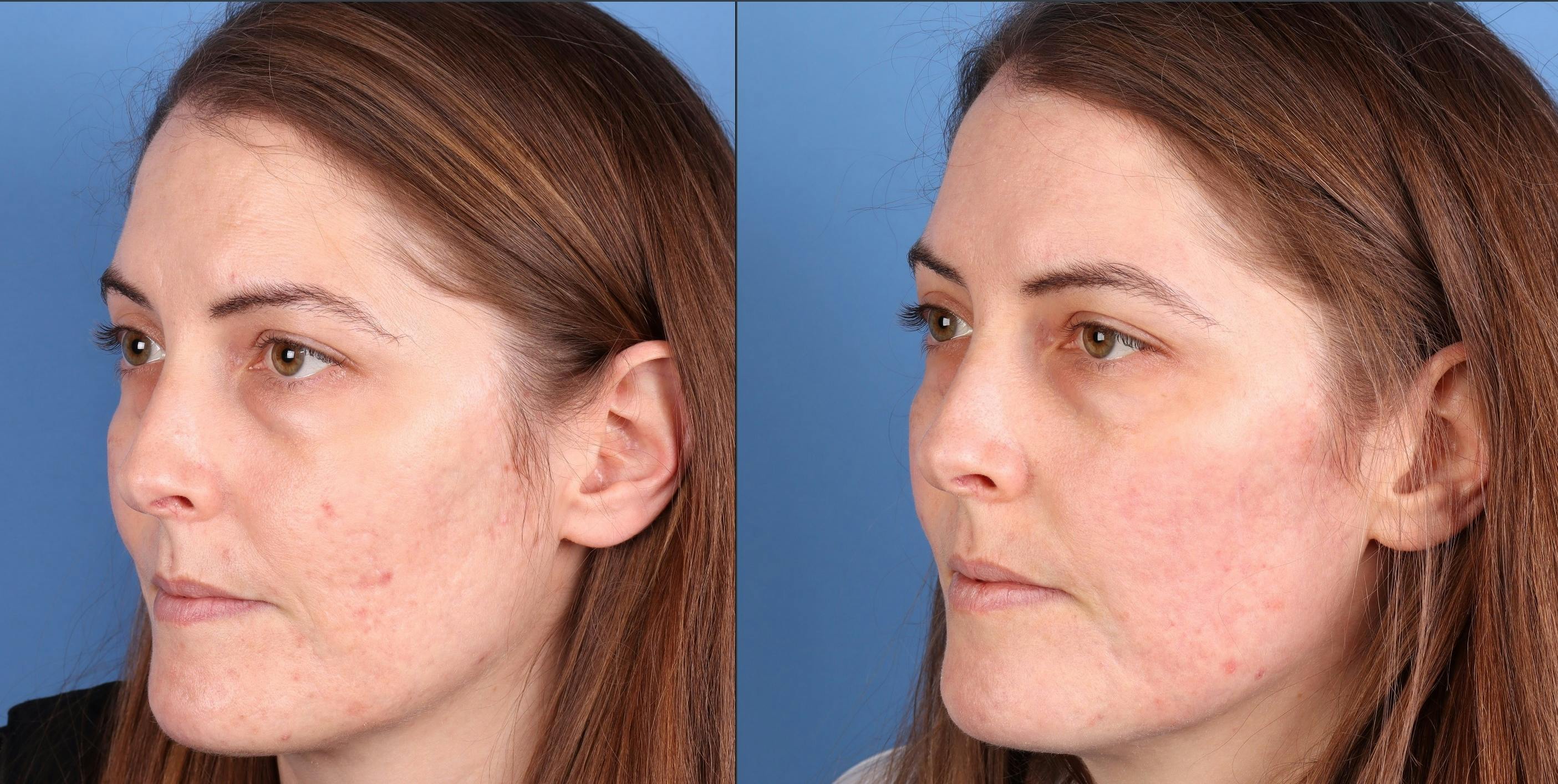Acne Scar Treatment Before & After Gallery - Patient 364535 - Image 5