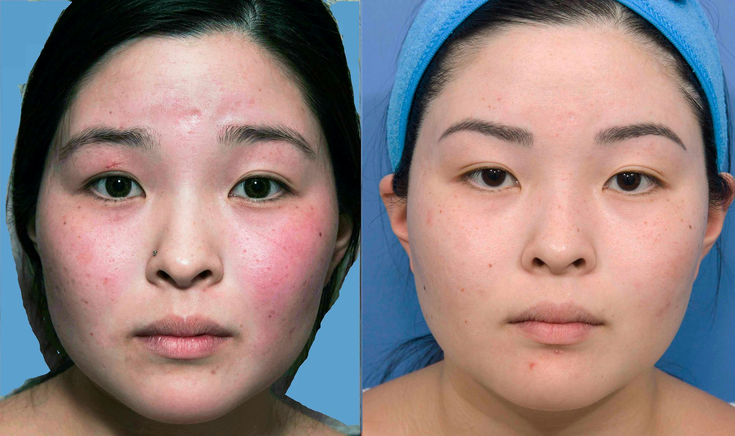 Acne Scar Treatment Before & After Gallery - Patient 152904 - Image 1