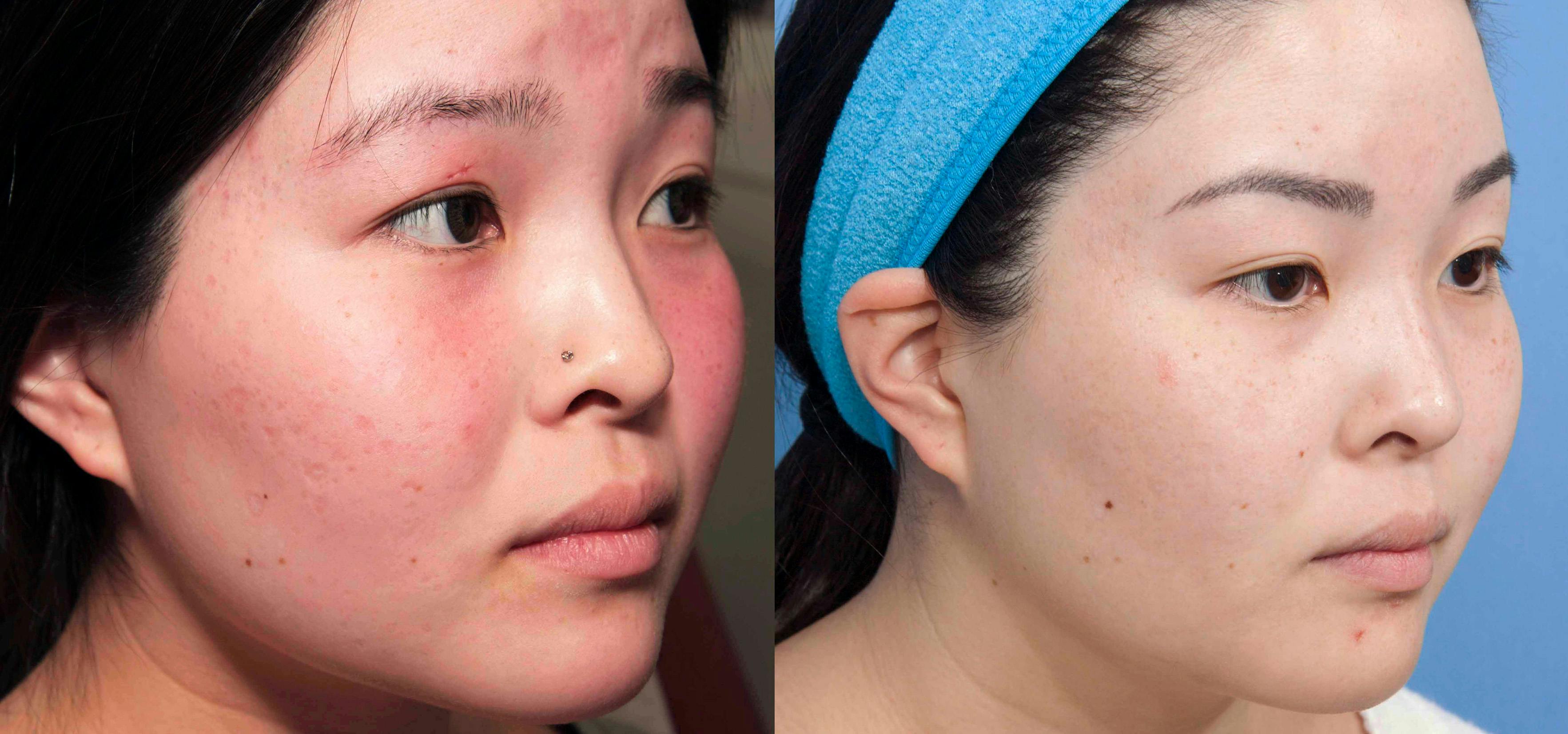 Acne Scar Treatment Before & After Gallery - Patient 152904 - Image 2