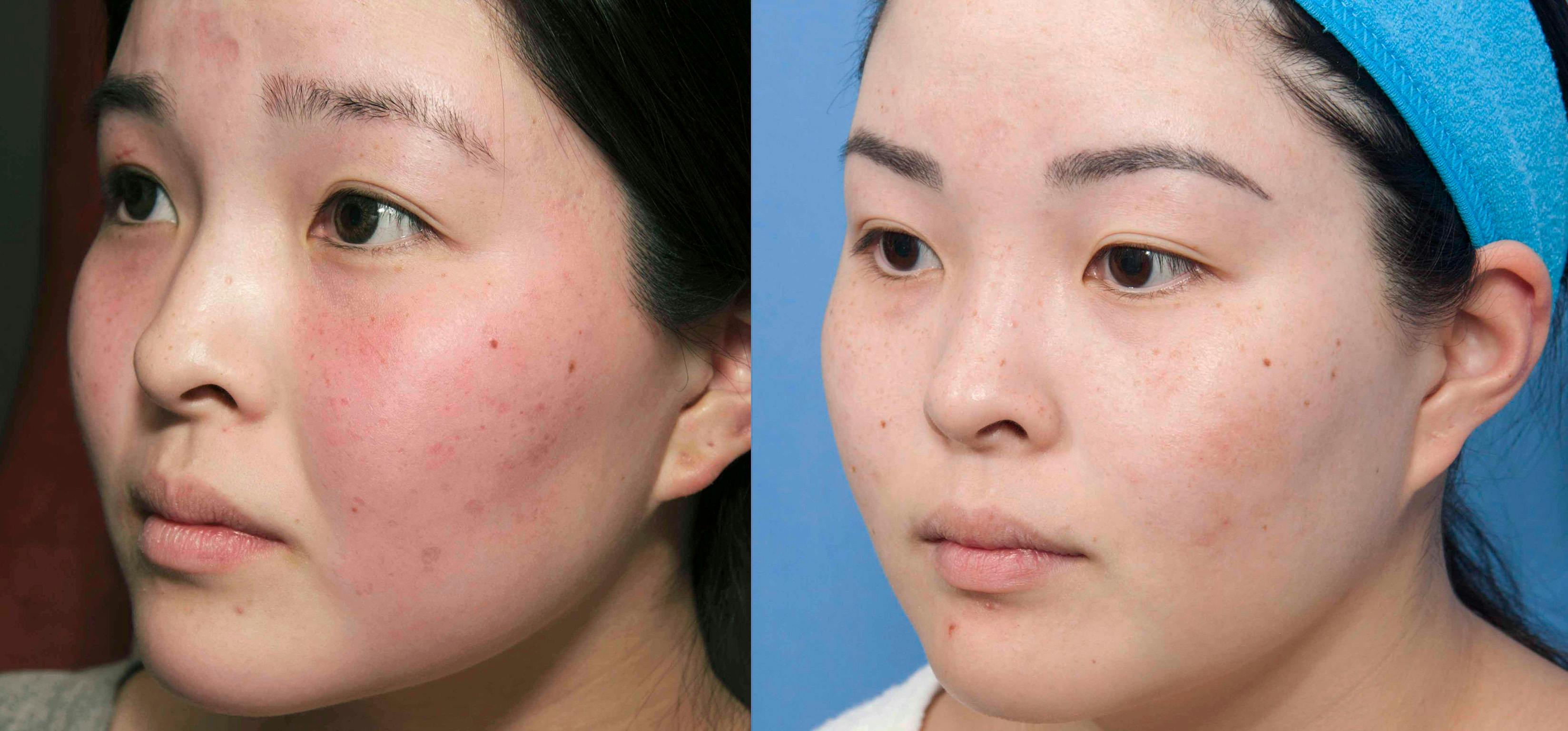 Acne Scar Treatment Before & After Gallery - Patient 152904 - Image 3