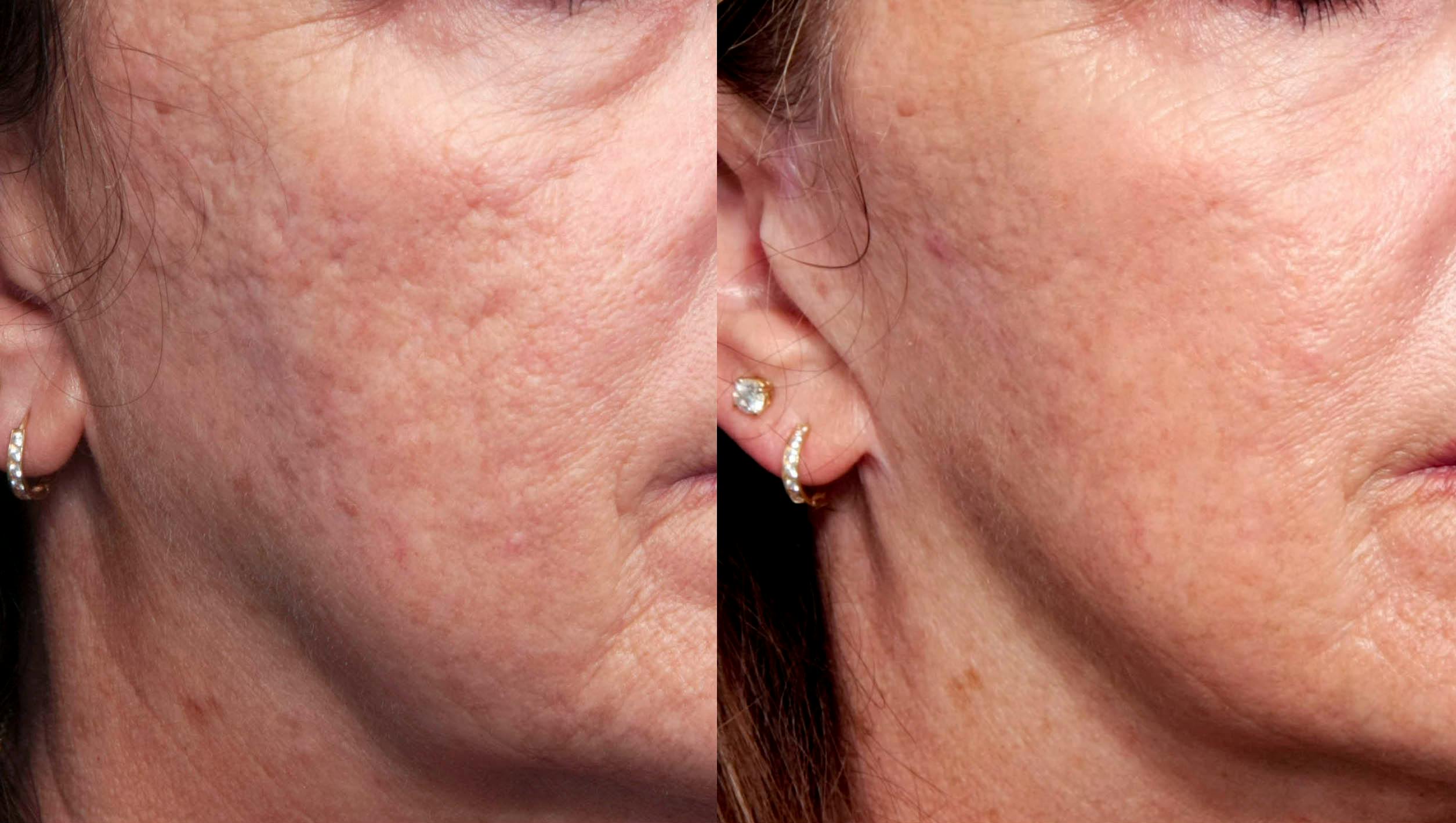 Acne Scar Treatment Before & After Gallery - Patient 231724 - Image 1