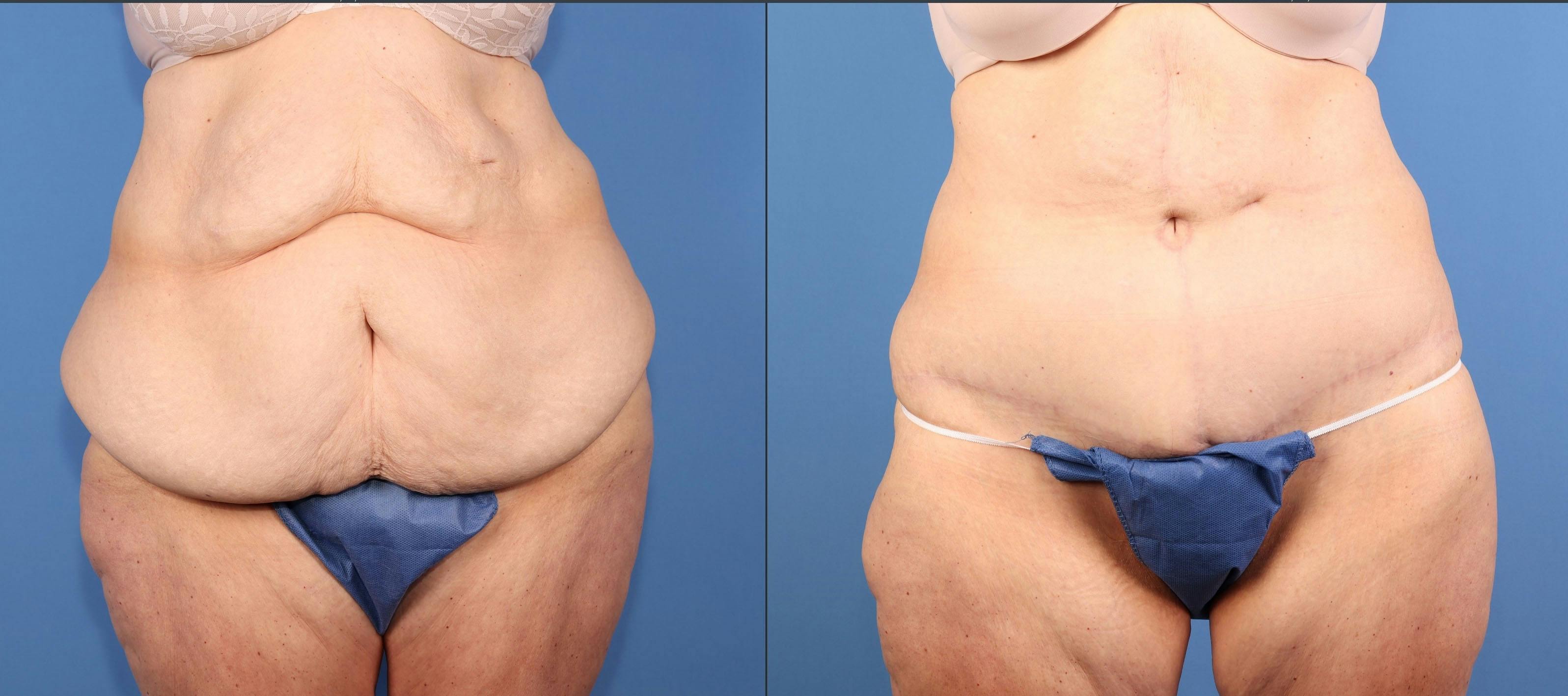 Tummy Tuck Before & After Gallery - Patient 417282 - Image 1