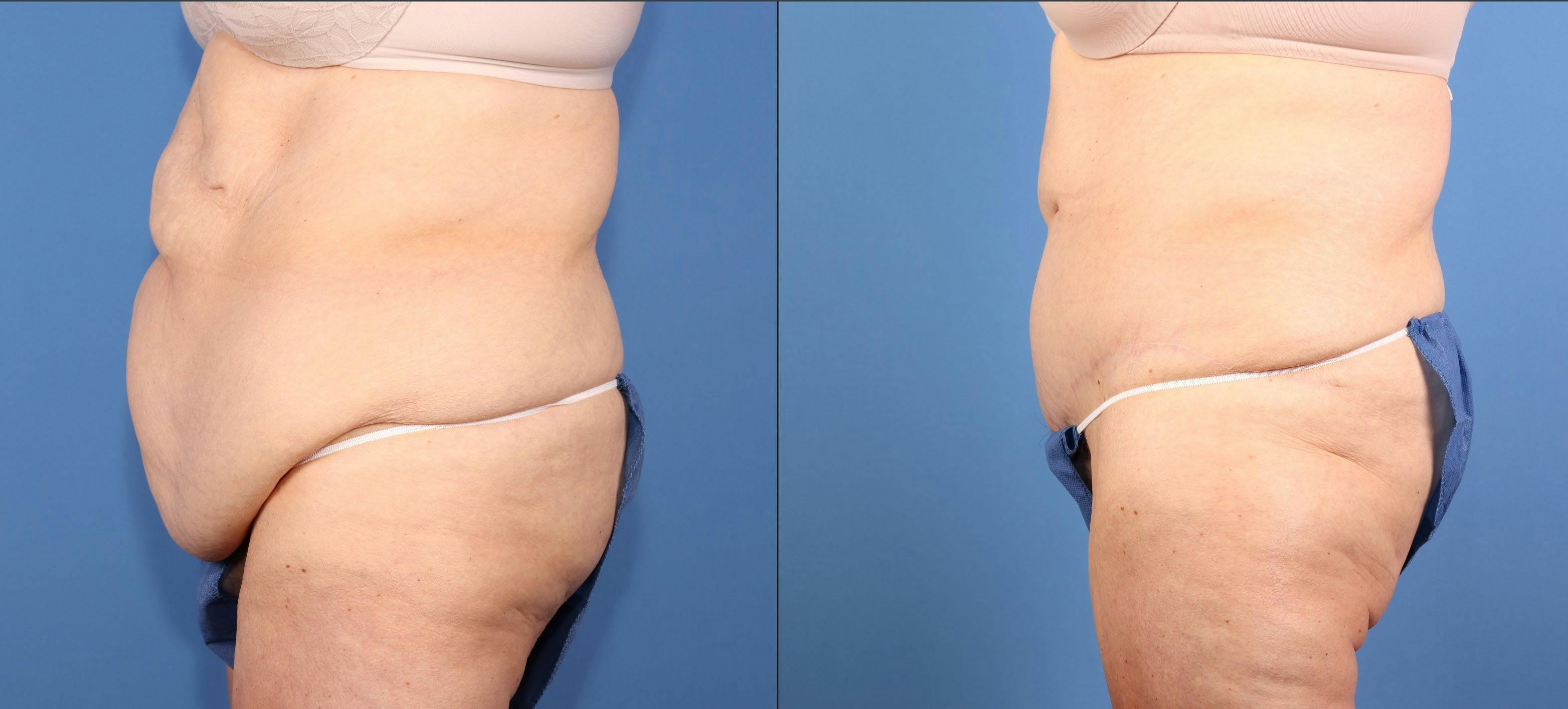 Tummy Tuck Before & After Gallery - Patient 417282 - Image 5