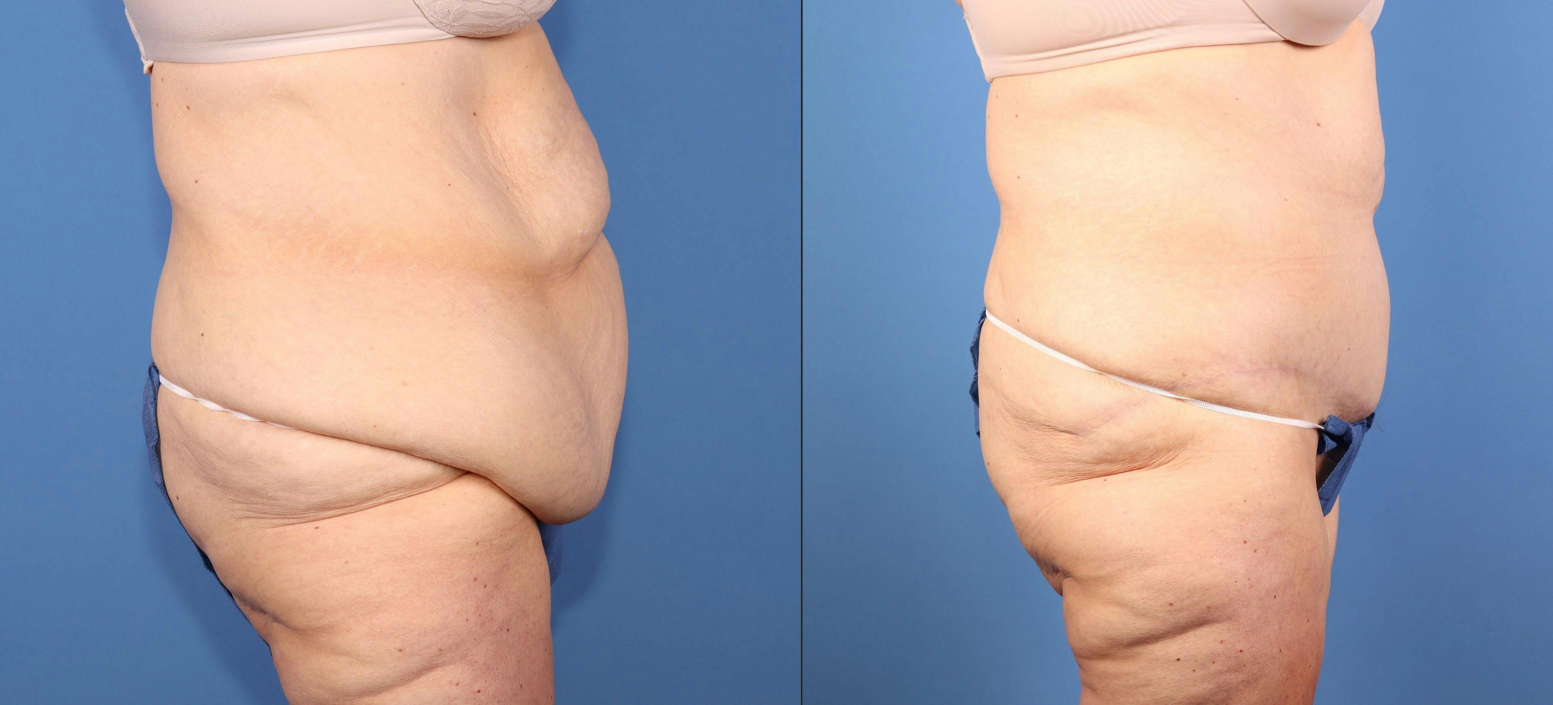 Tummy Tuck Before & After Gallery - Patient 417282 - Image 3