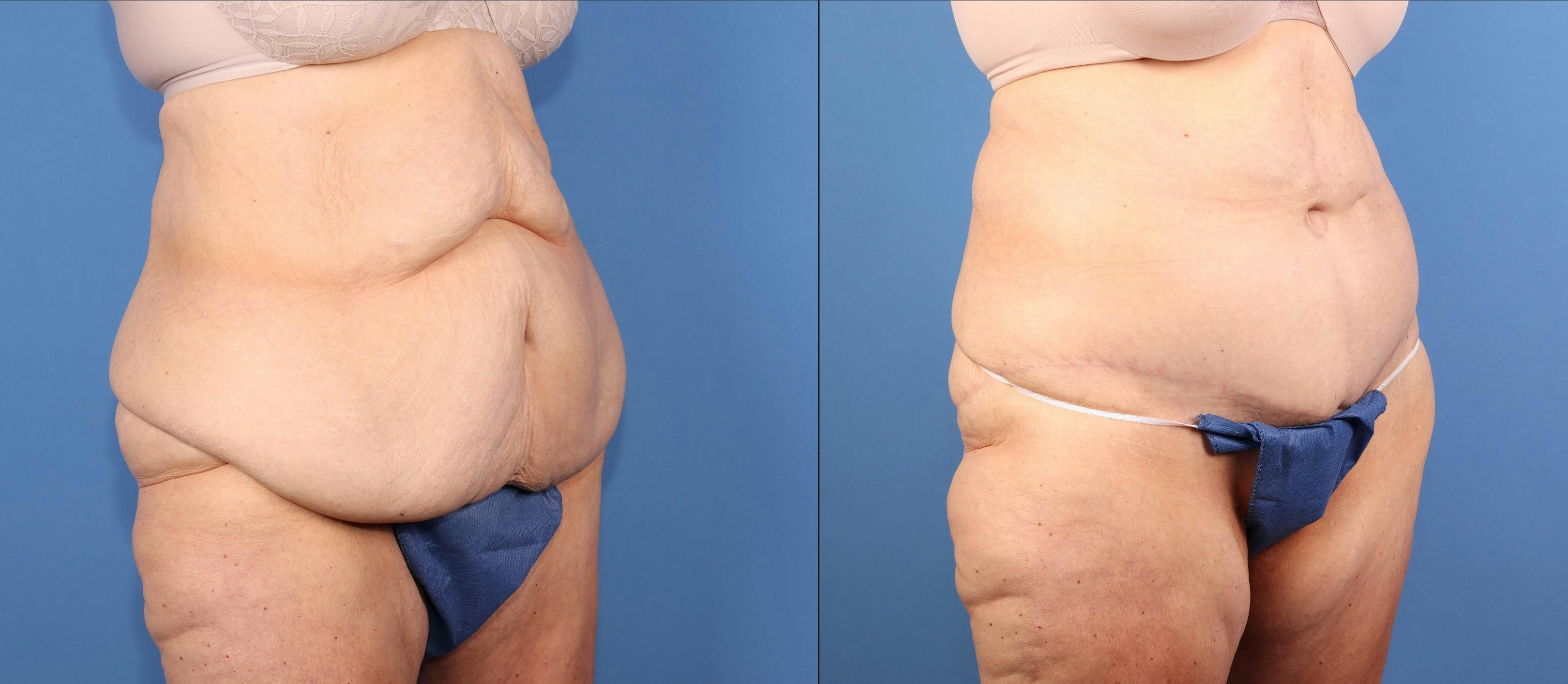Tummy Tuck Before & After Gallery - Patient 417282 - Image 2
