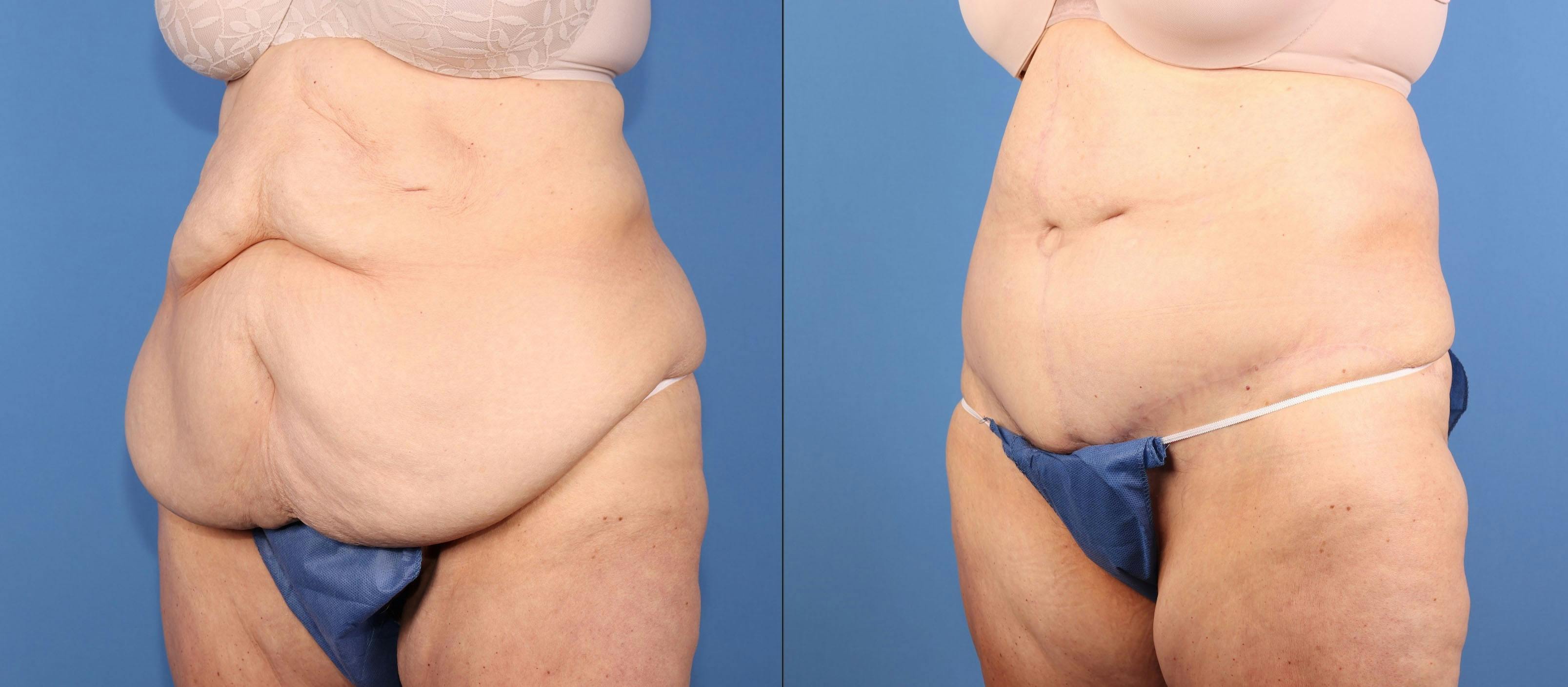 Tummy Tuck Before & After Gallery - Patient 417282 - Image 4