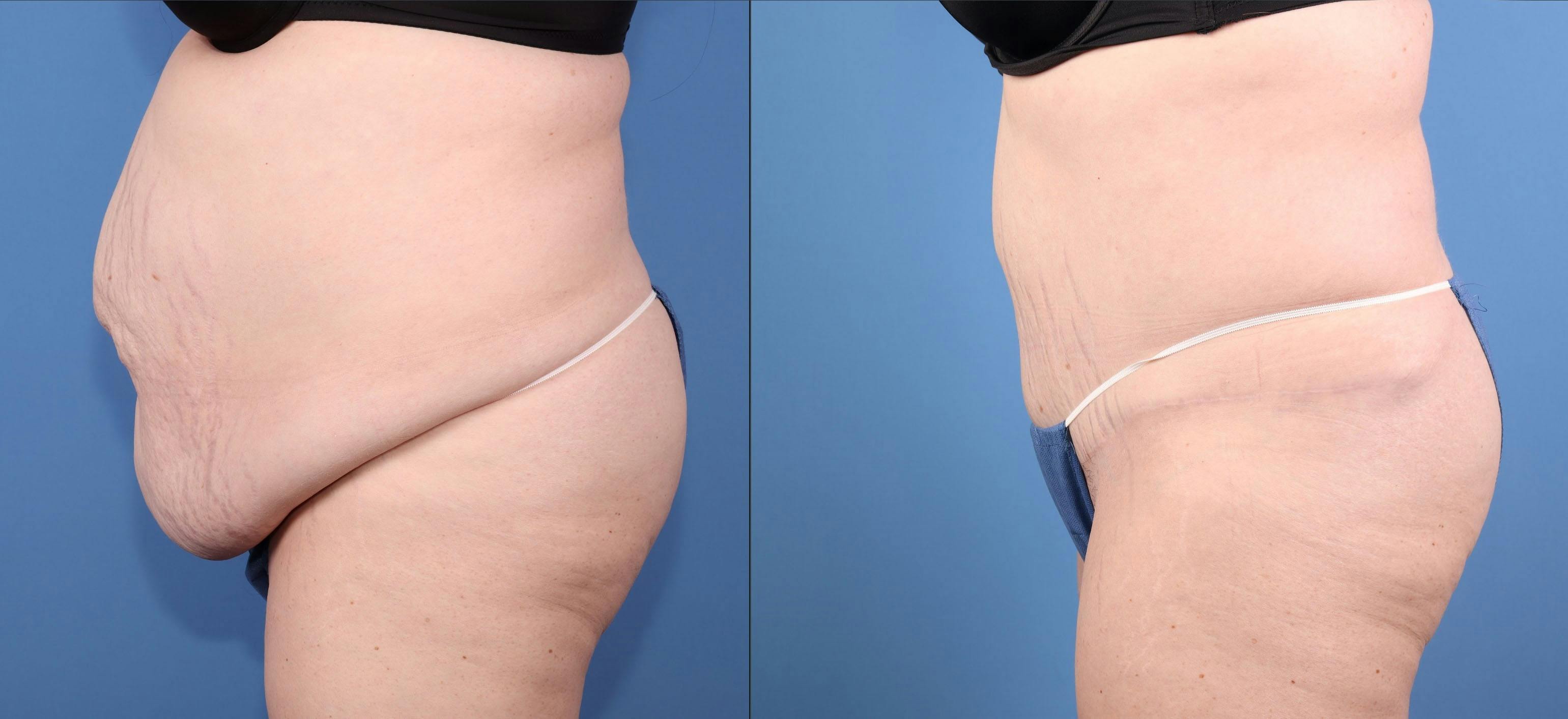 Abdomen Before & After Gallery - Patient 245924 - Image 3