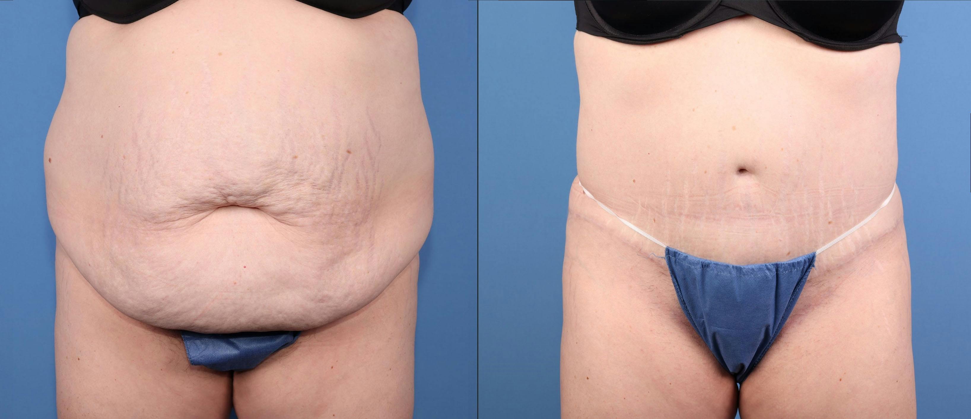 Abdomen Before & After Gallery - Patient 245924 - Image 1