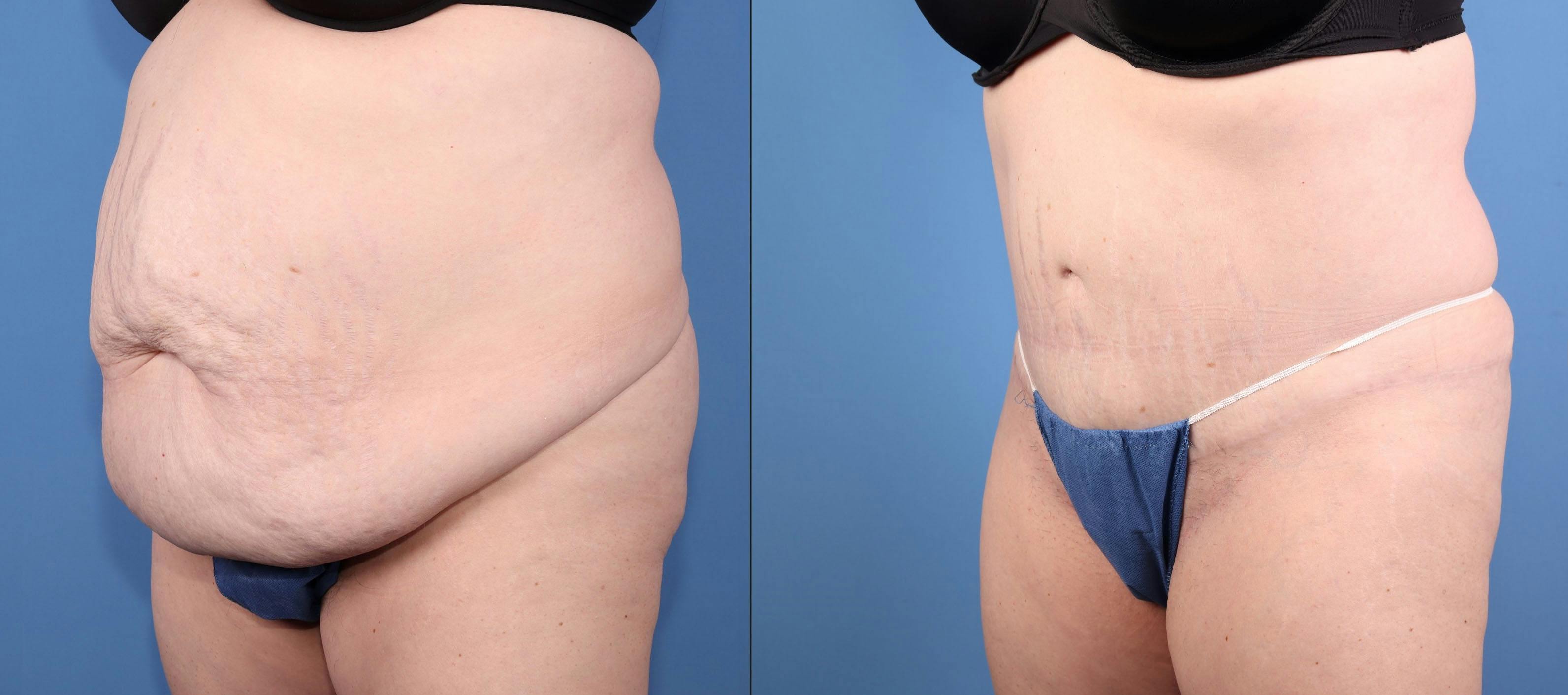 Abdomen Before & After Gallery - Patient 245924 - Image 2