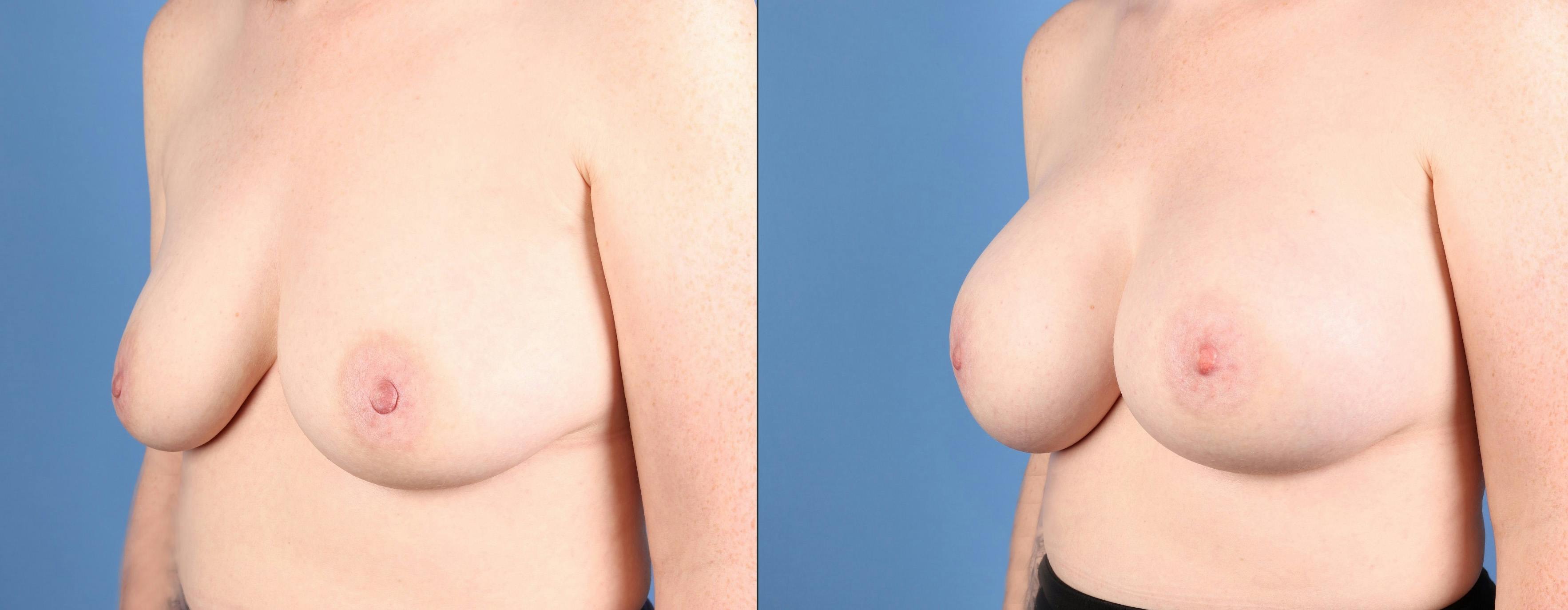 Breast Augmentation Before & After Gallery - Patient 384753 - Image 2