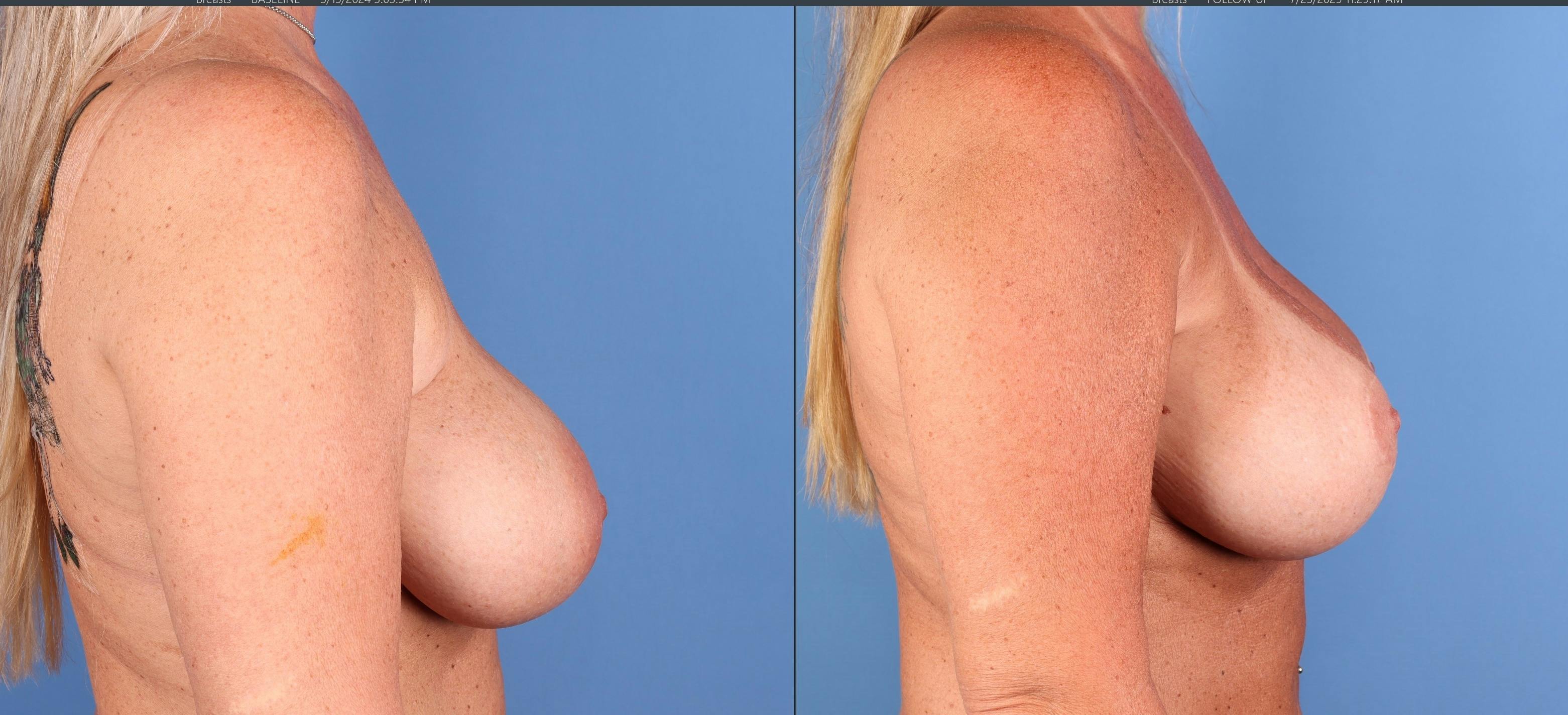 Breast Revision Before & After Gallery - Patient 425841 - Image 3