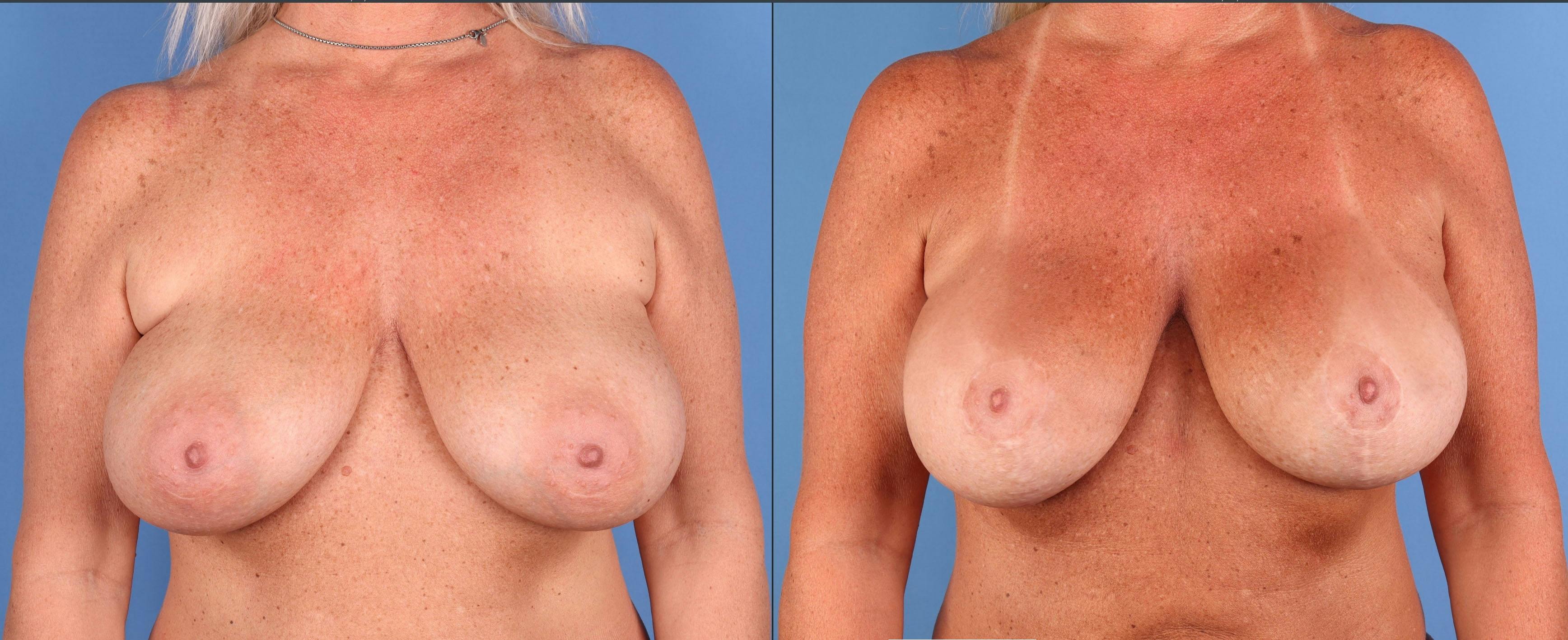 Breast Revision Before & After Gallery - Patient 425841 - Image 1