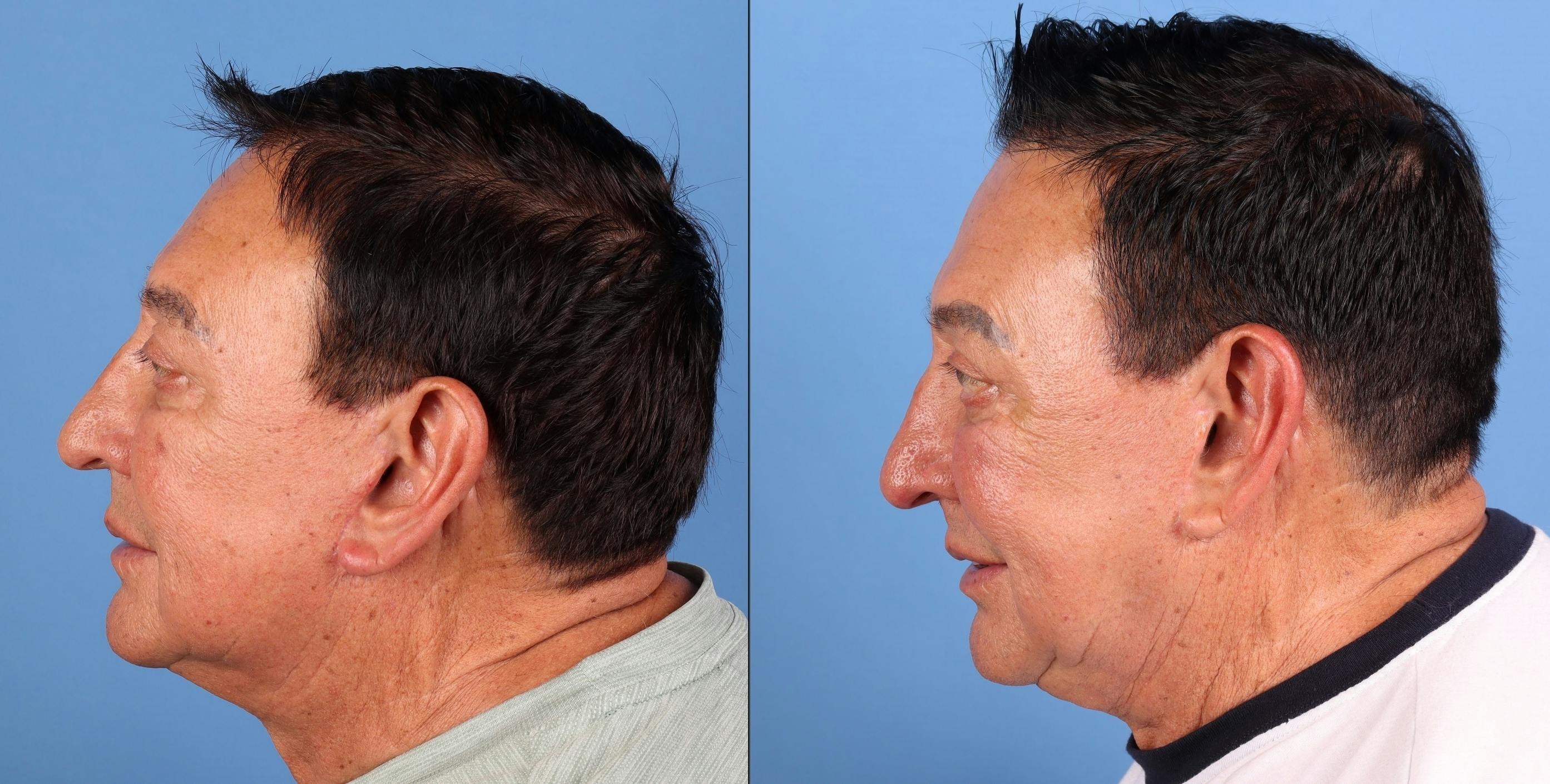 Contour TRL Laser Before & After Gallery - Patient 261589 - Image 5