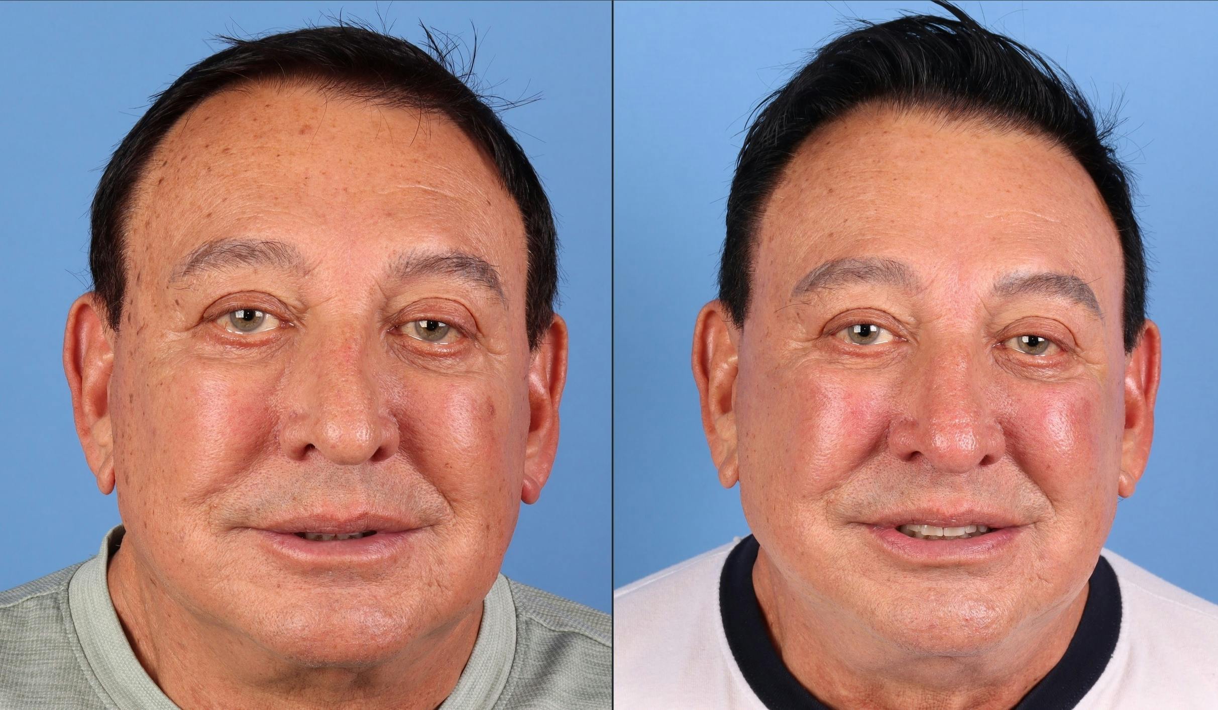 Contour TRL Laser Before & After Gallery - Patient 261589 - Image 1