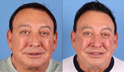 Contour TRL Laser Before & After Gallery - Patient 261589 - Image 1