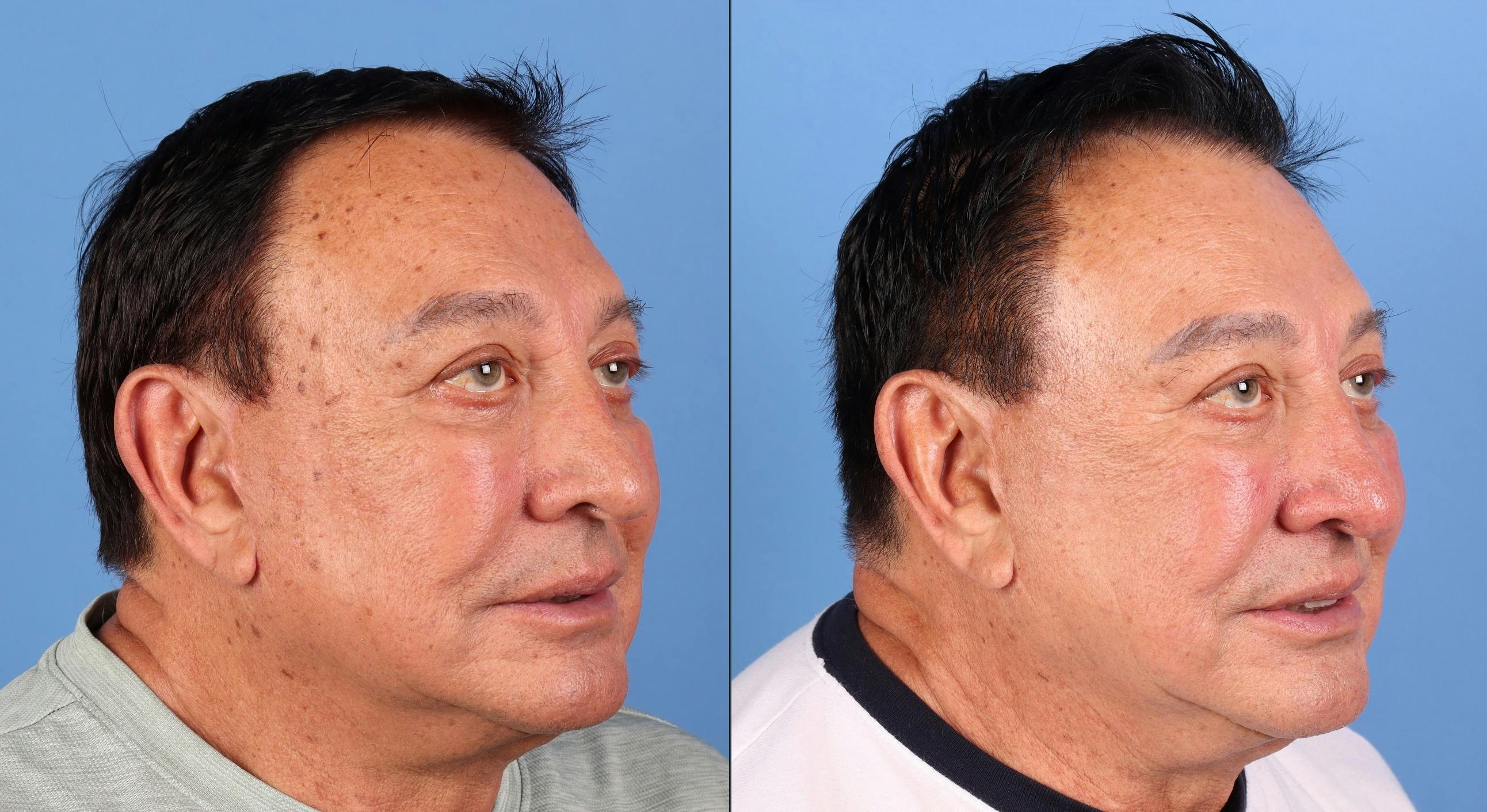 Contour TRL Laser Before & After Gallery - Patient 261589 - Image 2