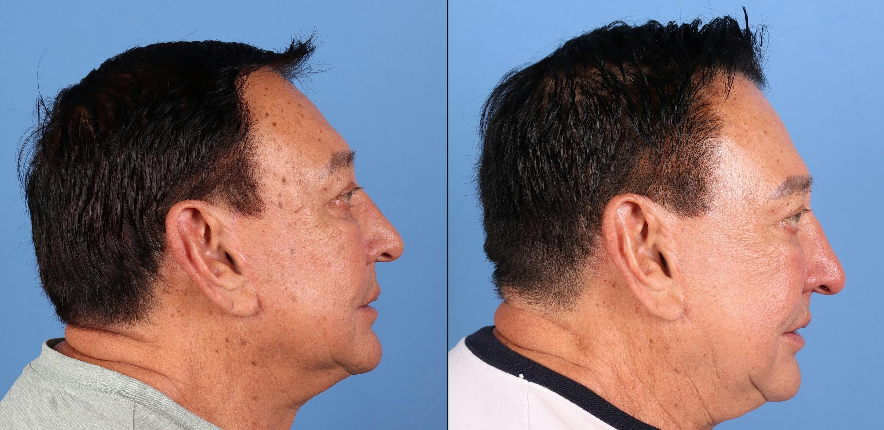 Contour TRL Laser Before & After Gallery - Patient 261589 - Image 3