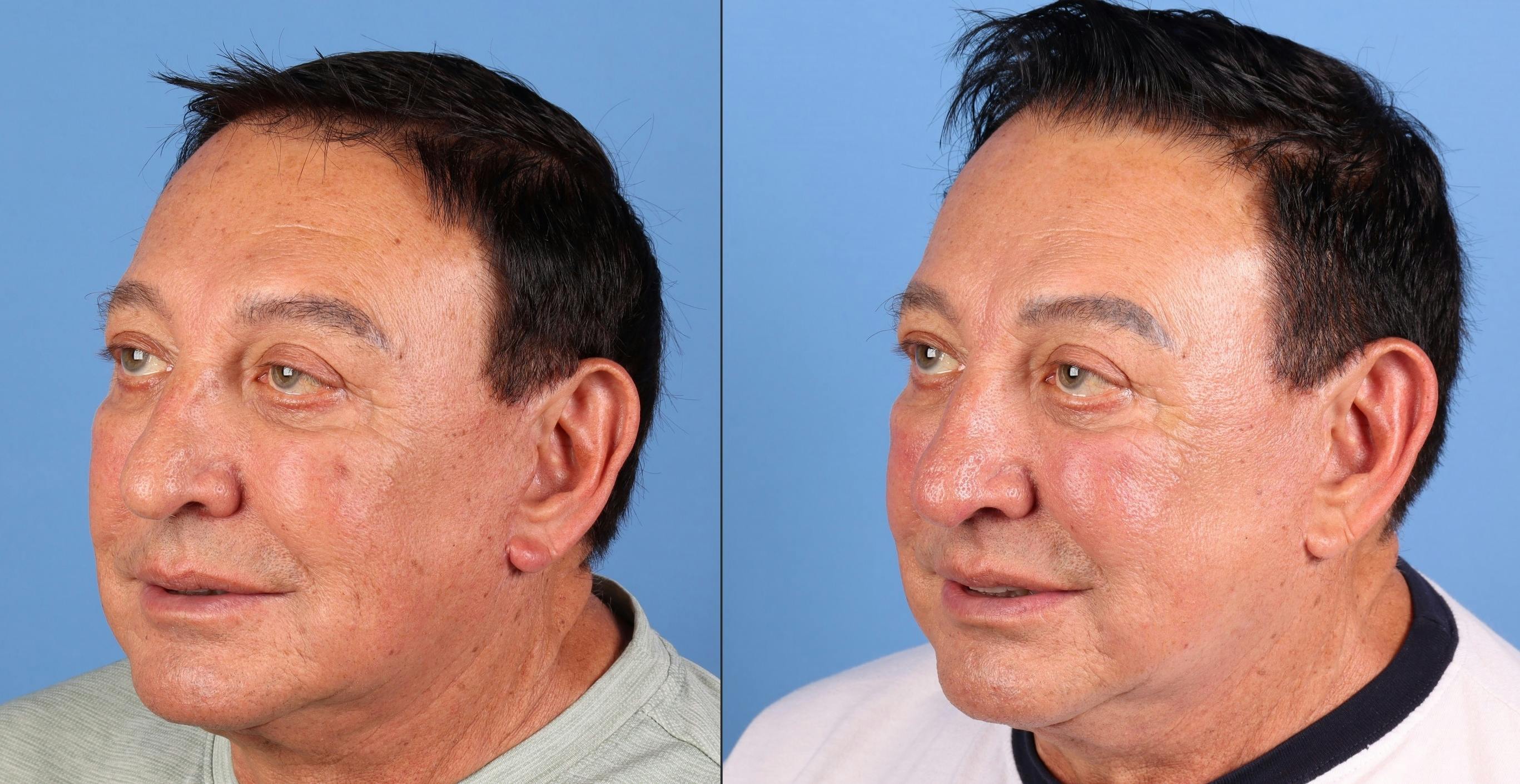 Contour TRL Laser Before & After Gallery - Patient 261589 - Image 4