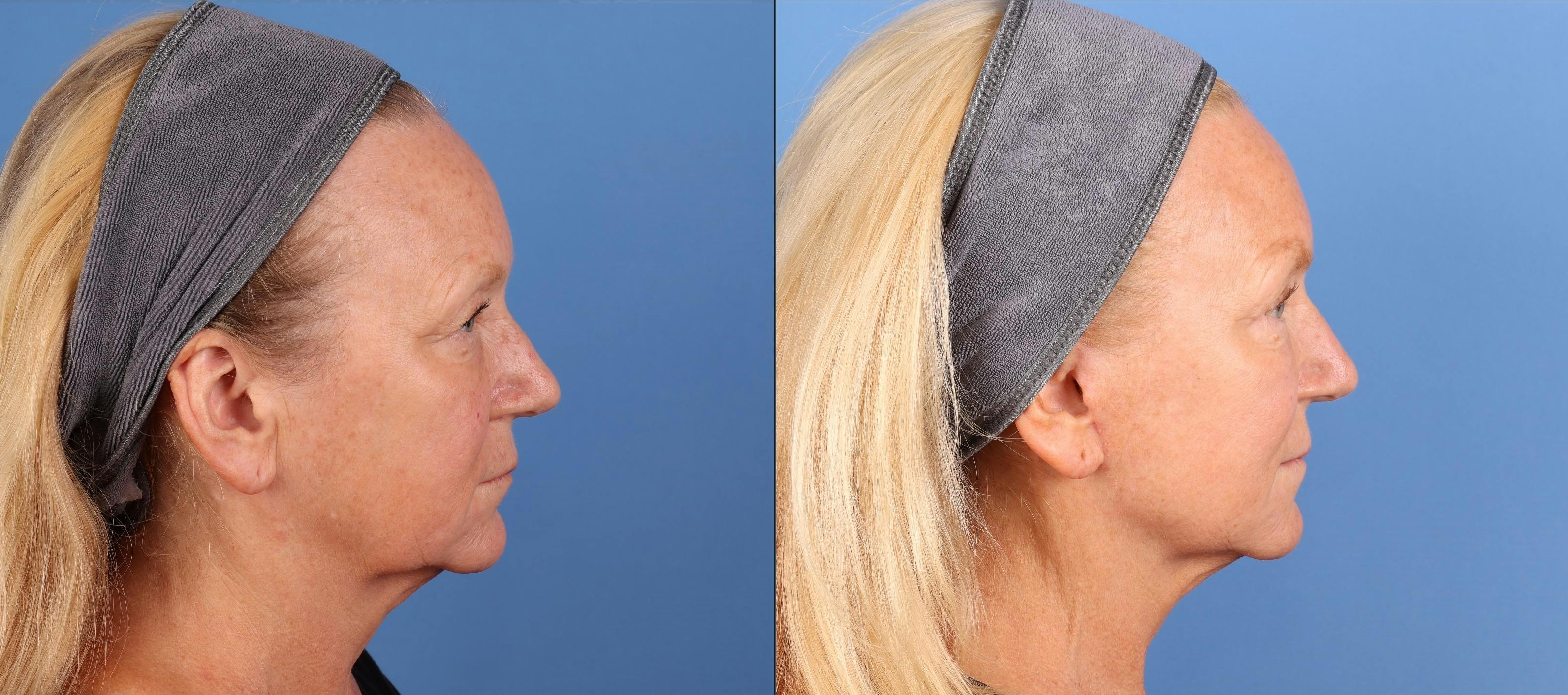 Face Lift Before & After Gallery - Patient 312031 - Image 5