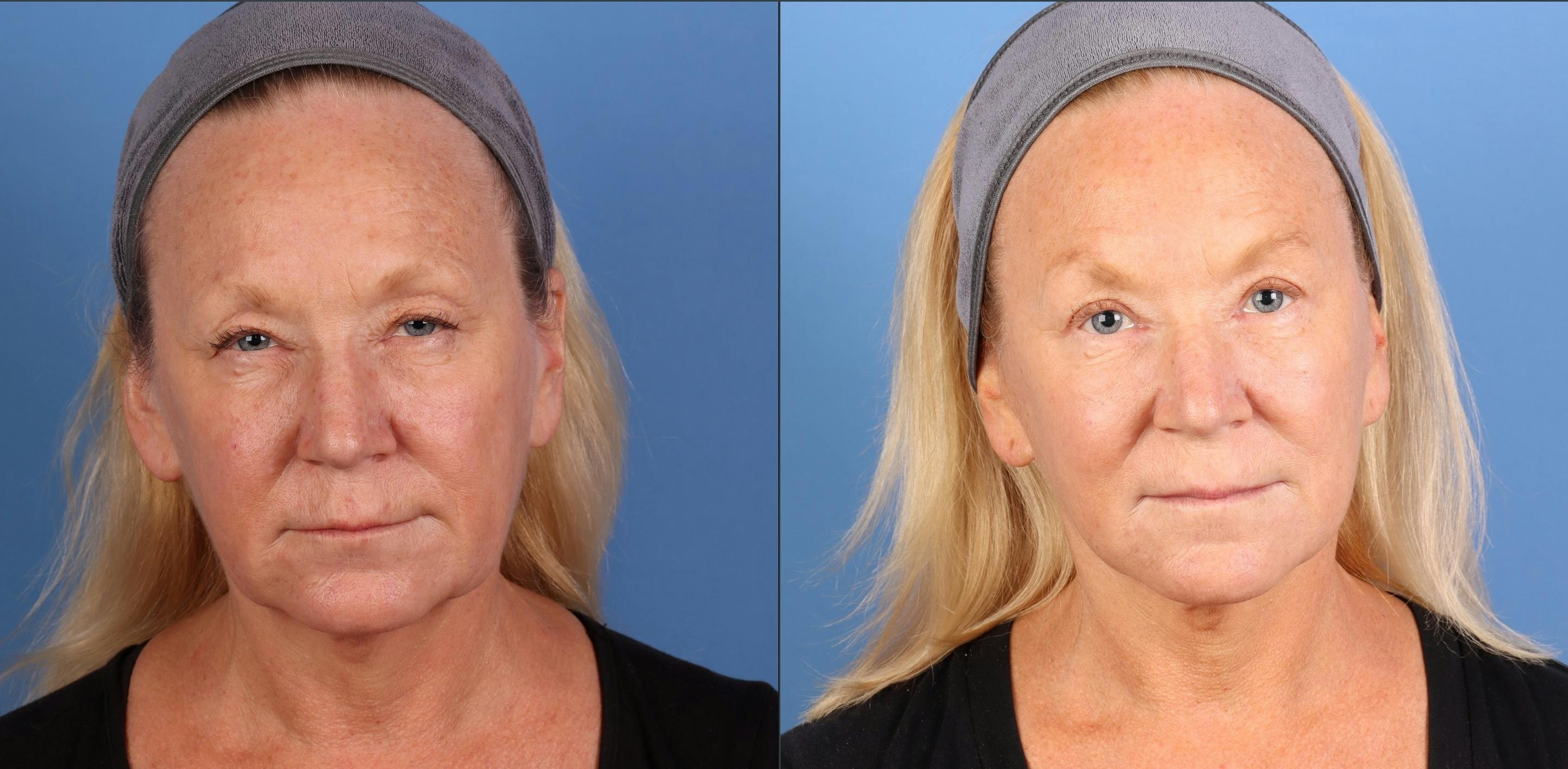 Eyelid Surgery (Upper Blepharoplasty) Before & After Gallery - Patient 338278 - Image 1