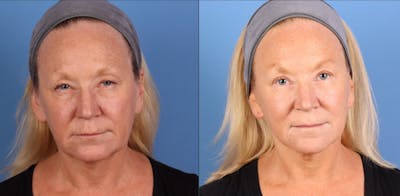 Eyelid Surgery (Upper Blepharoplasty) Before & After Gallery - Patient 338278 - Image 1
