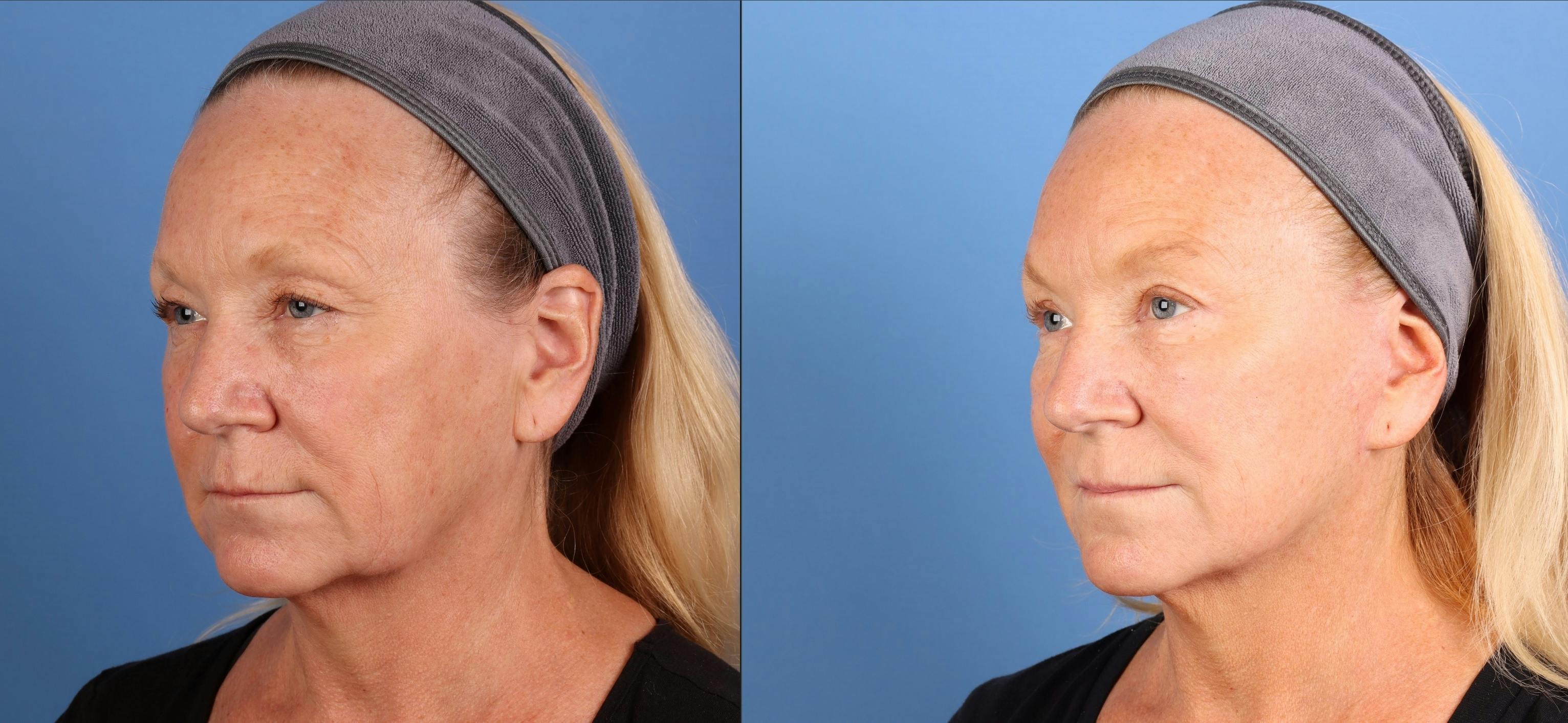 Face Lift Before & After Gallery - Patient 312031 - Image 2
