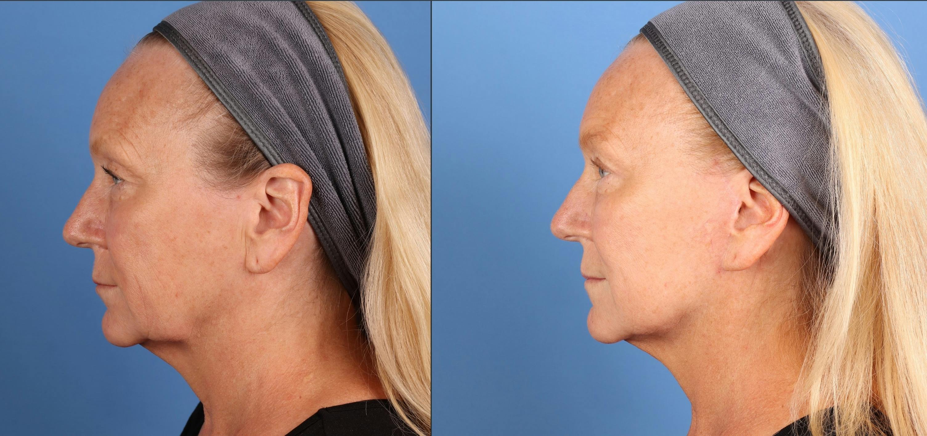 Face Lift Before & After Gallery - Patient 312031 - Image 3