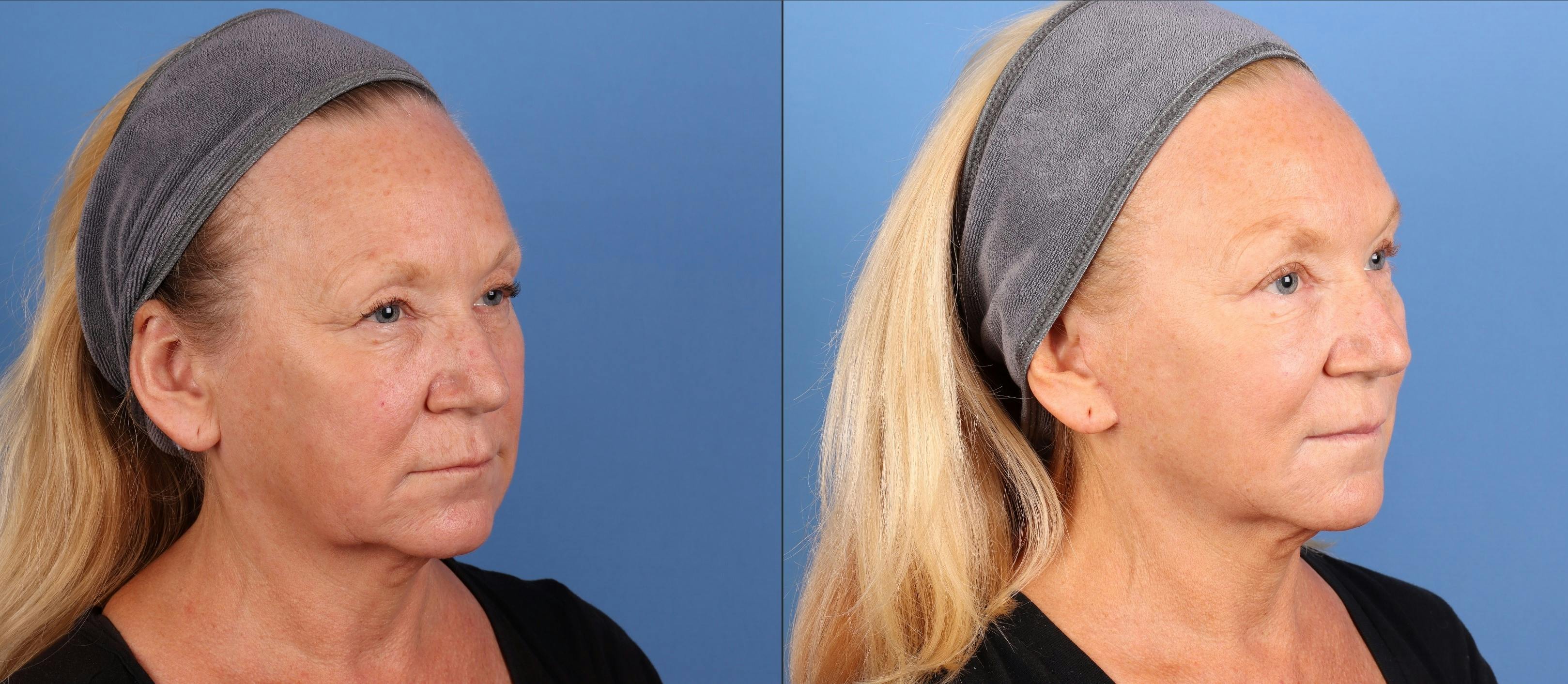 Face Lift Before & After Gallery - Patient 312031 - Image 4