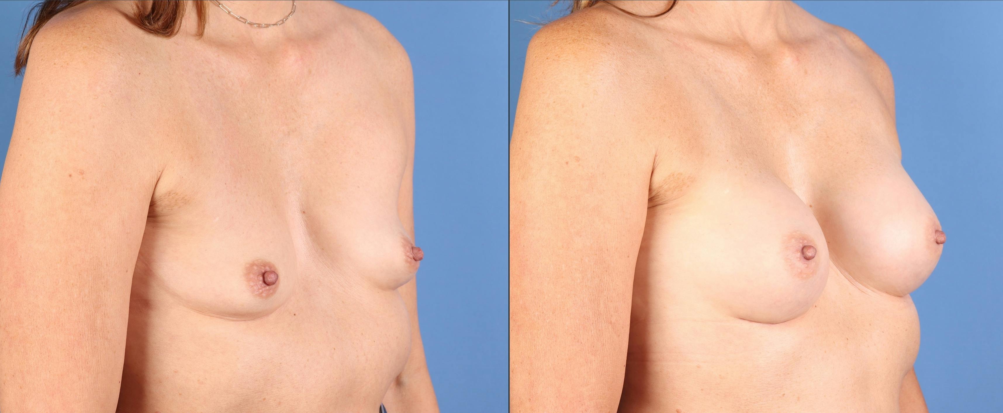 Breast Augmentation Before & After Gallery - Patient 113174 - Image 2
