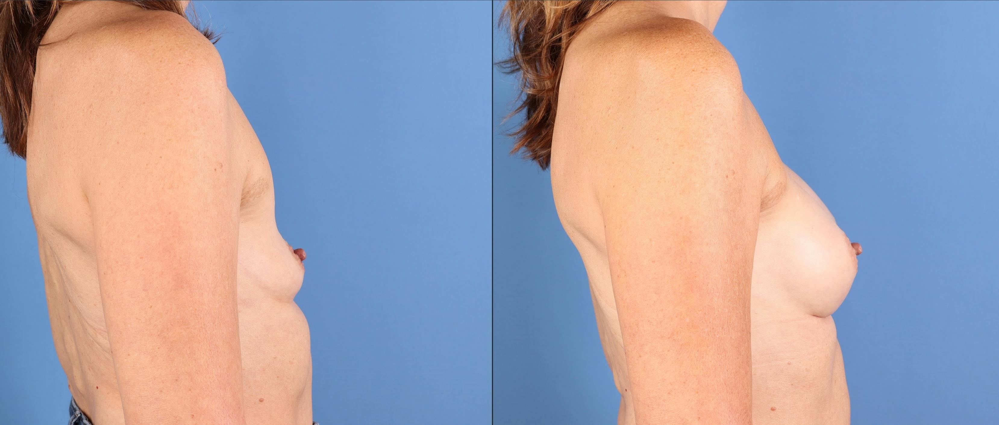Breast Augmentation Before & After Gallery - Patient 113174 - Image 3