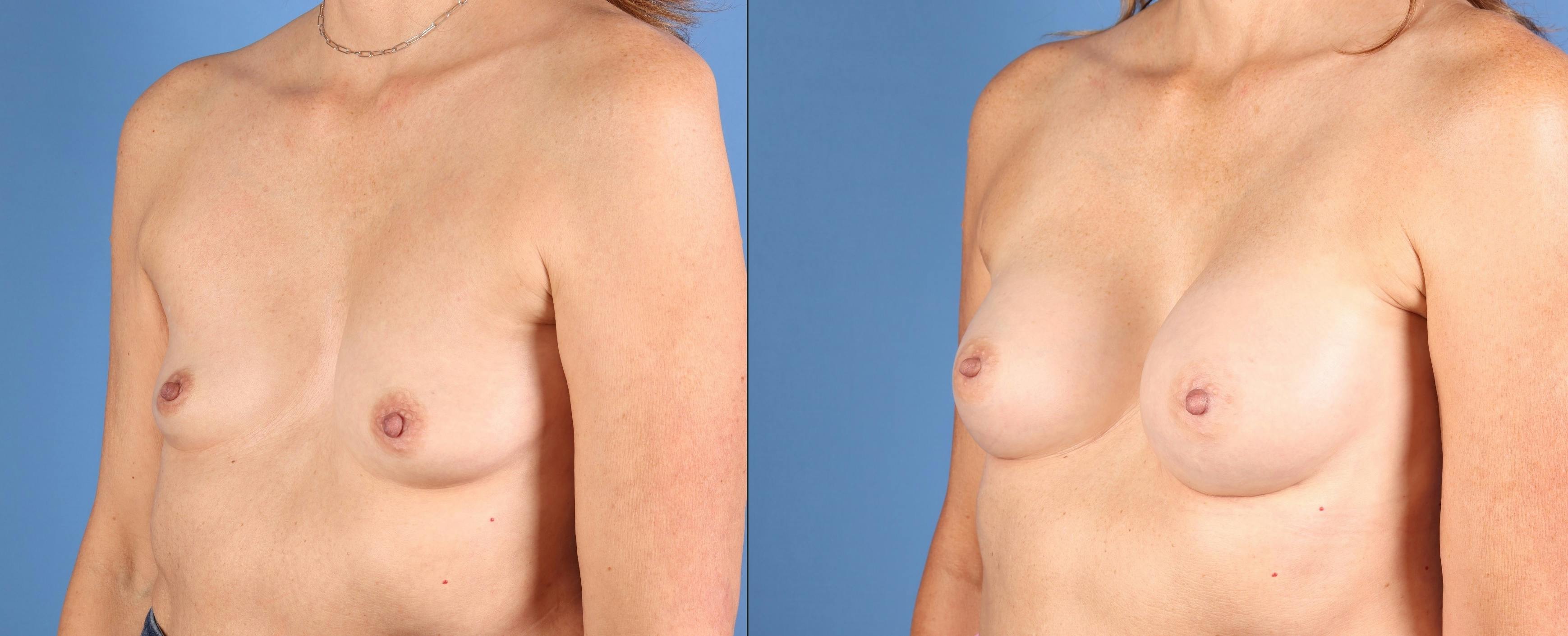 Breast Augmentation Before & After Gallery - Patient 113174 - Image 4