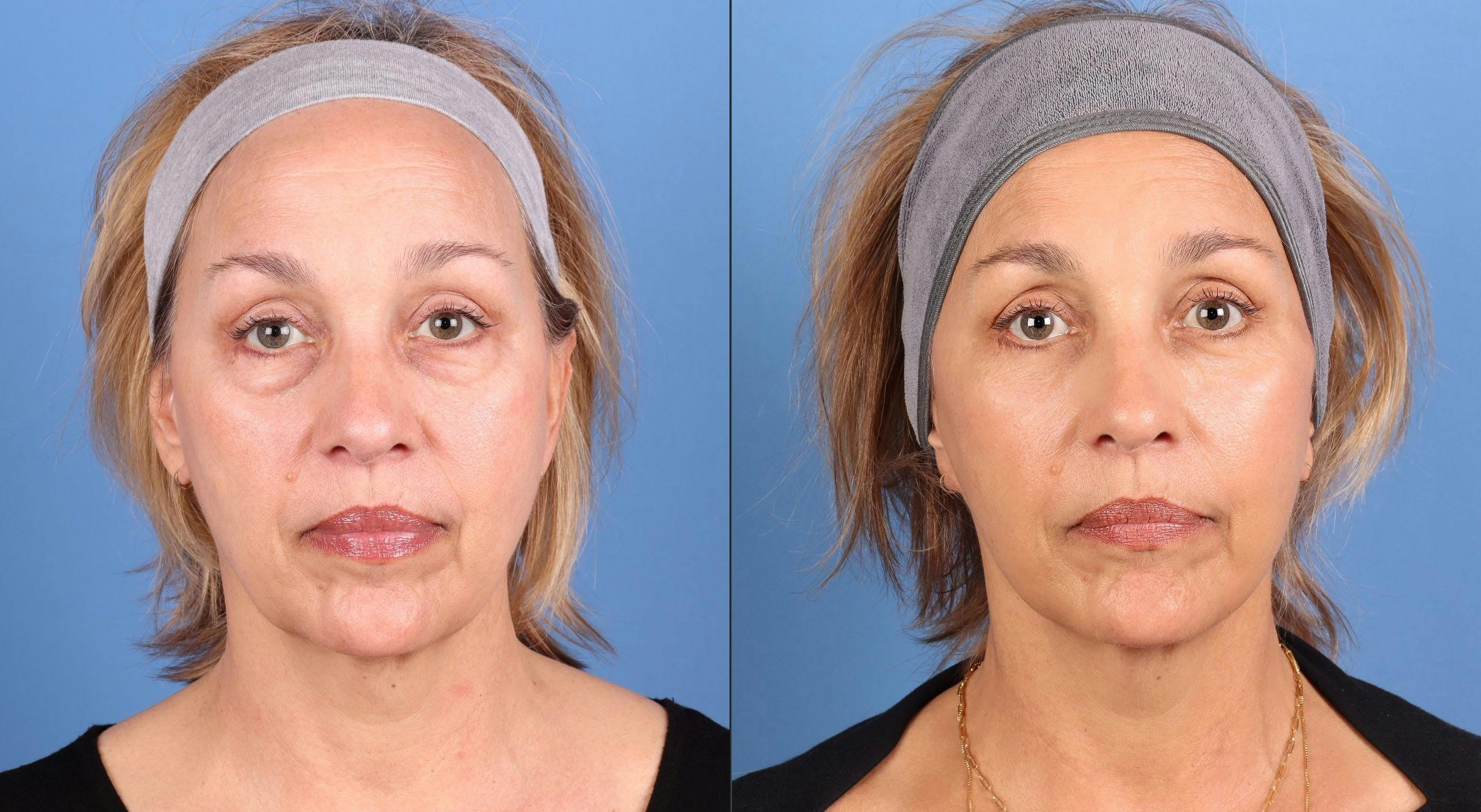Eyelid Surgery (Lower Blepharoplasty) Before & After Gallery - Patient 313442 - Image 1