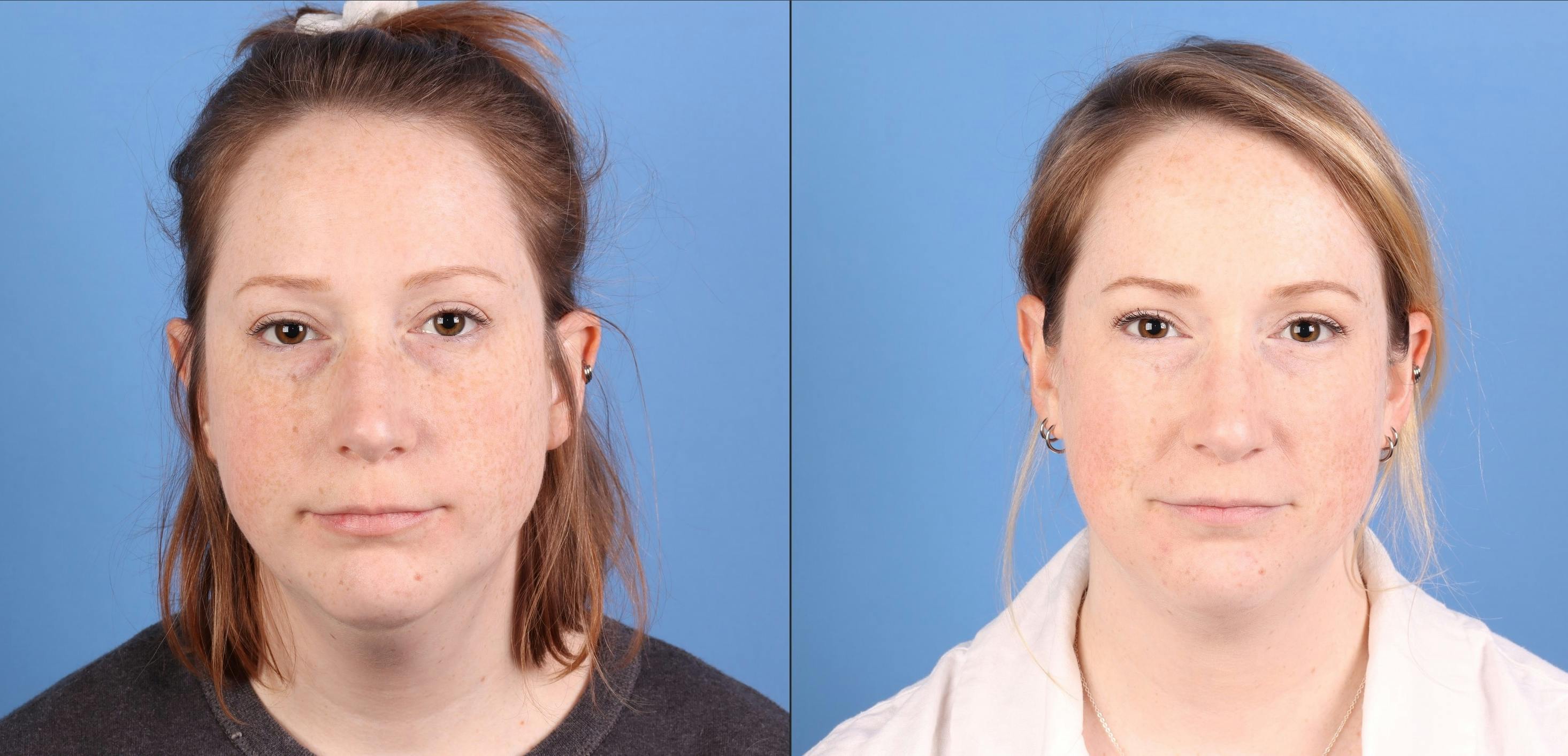 Face & Neck Before & After Gallery - Patient 345880 - Image 1