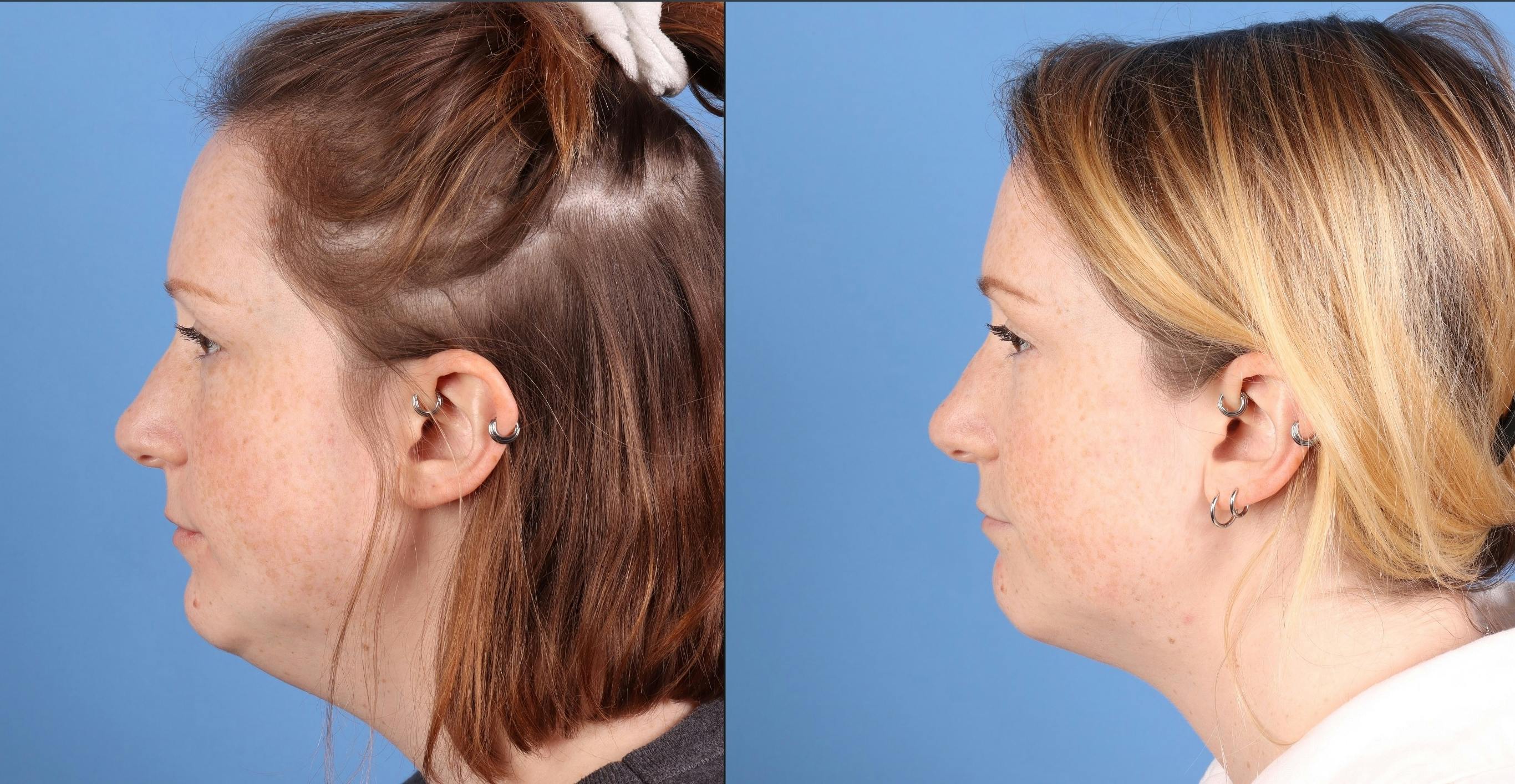 Face & Neck Before & After Gallery - Patient 345880 - Image 3